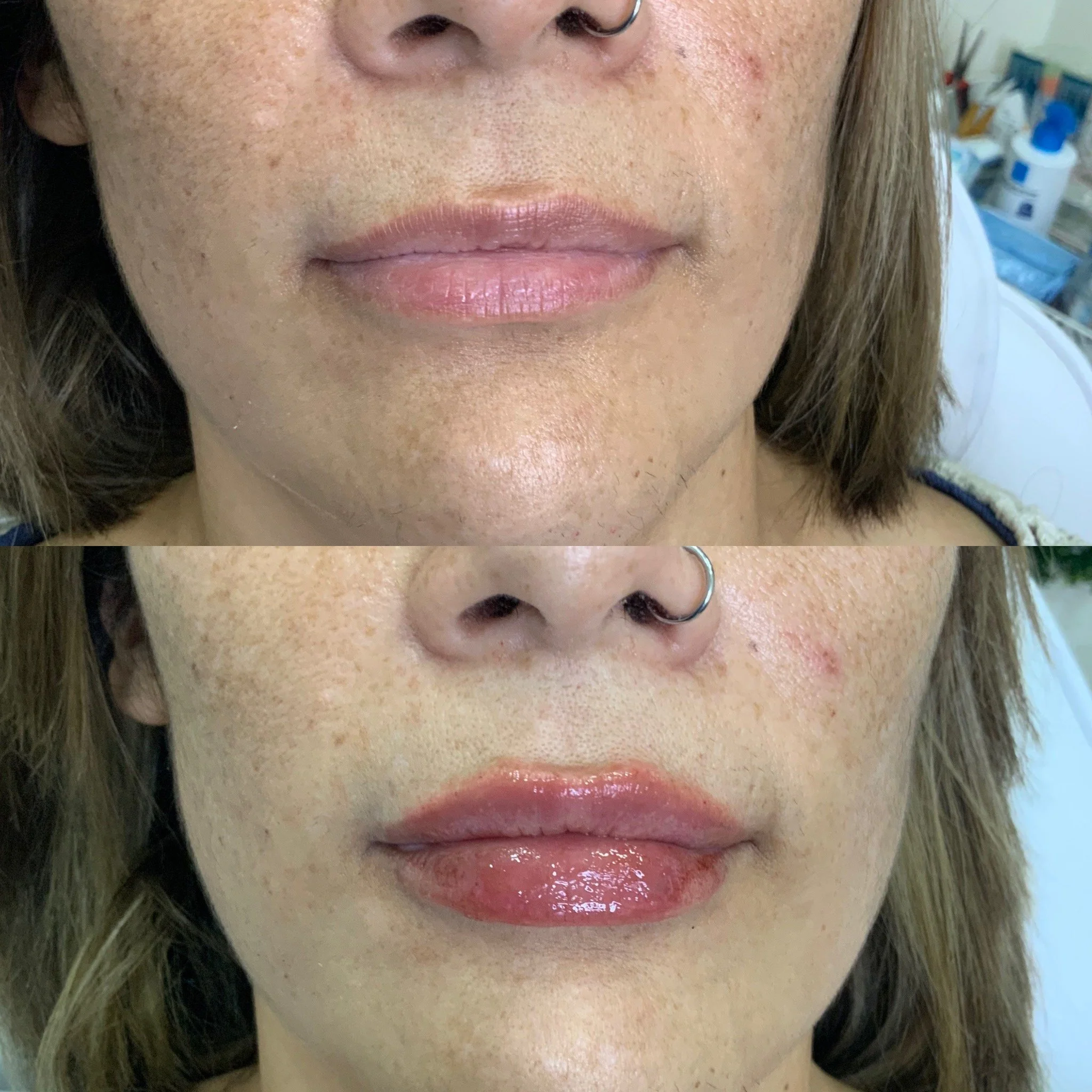 Lip FIller