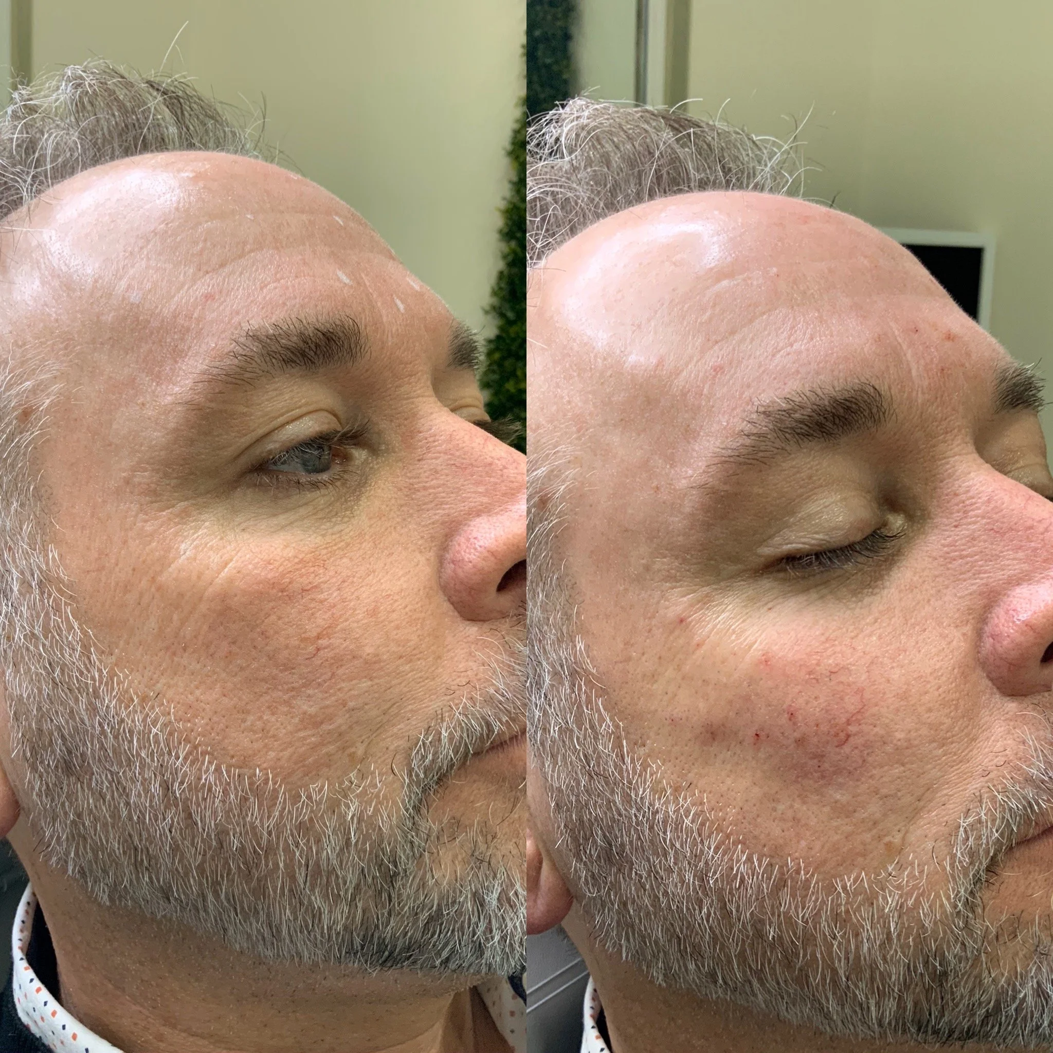 Cheek Filler