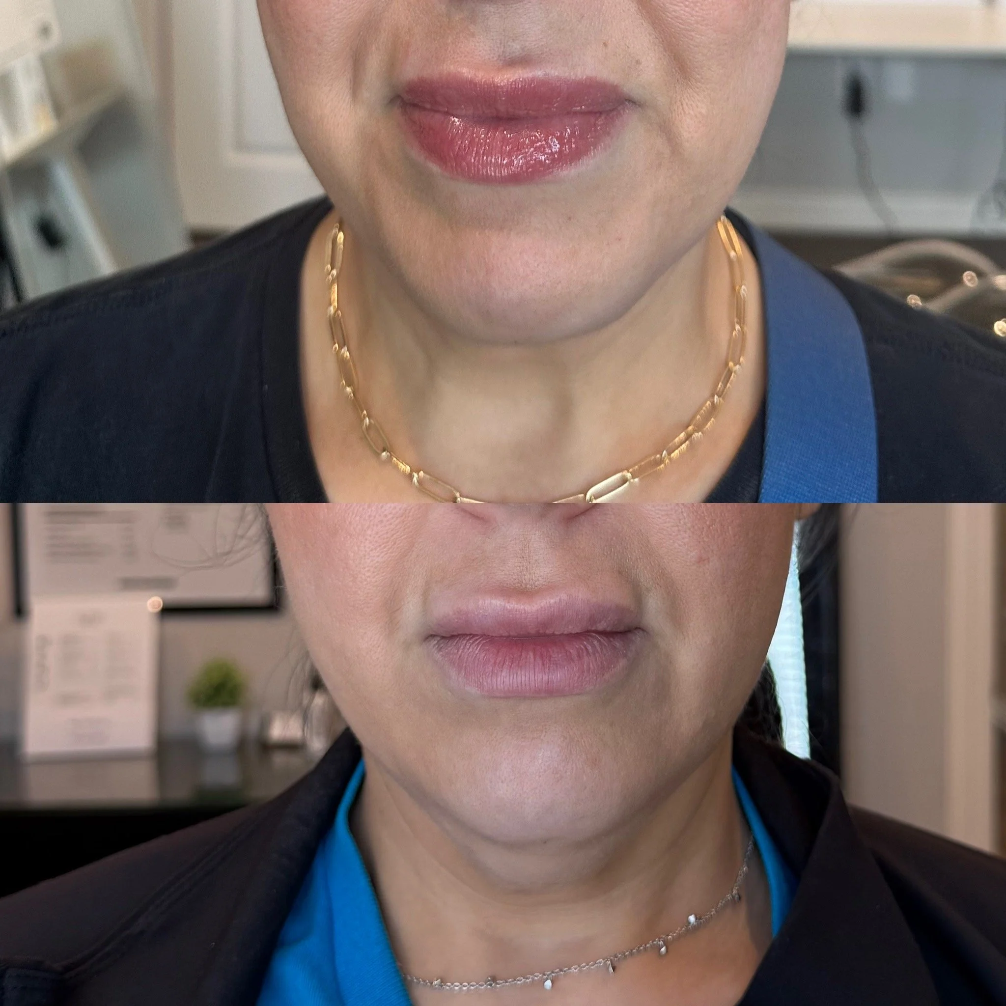 chin fat dissolver.JPG