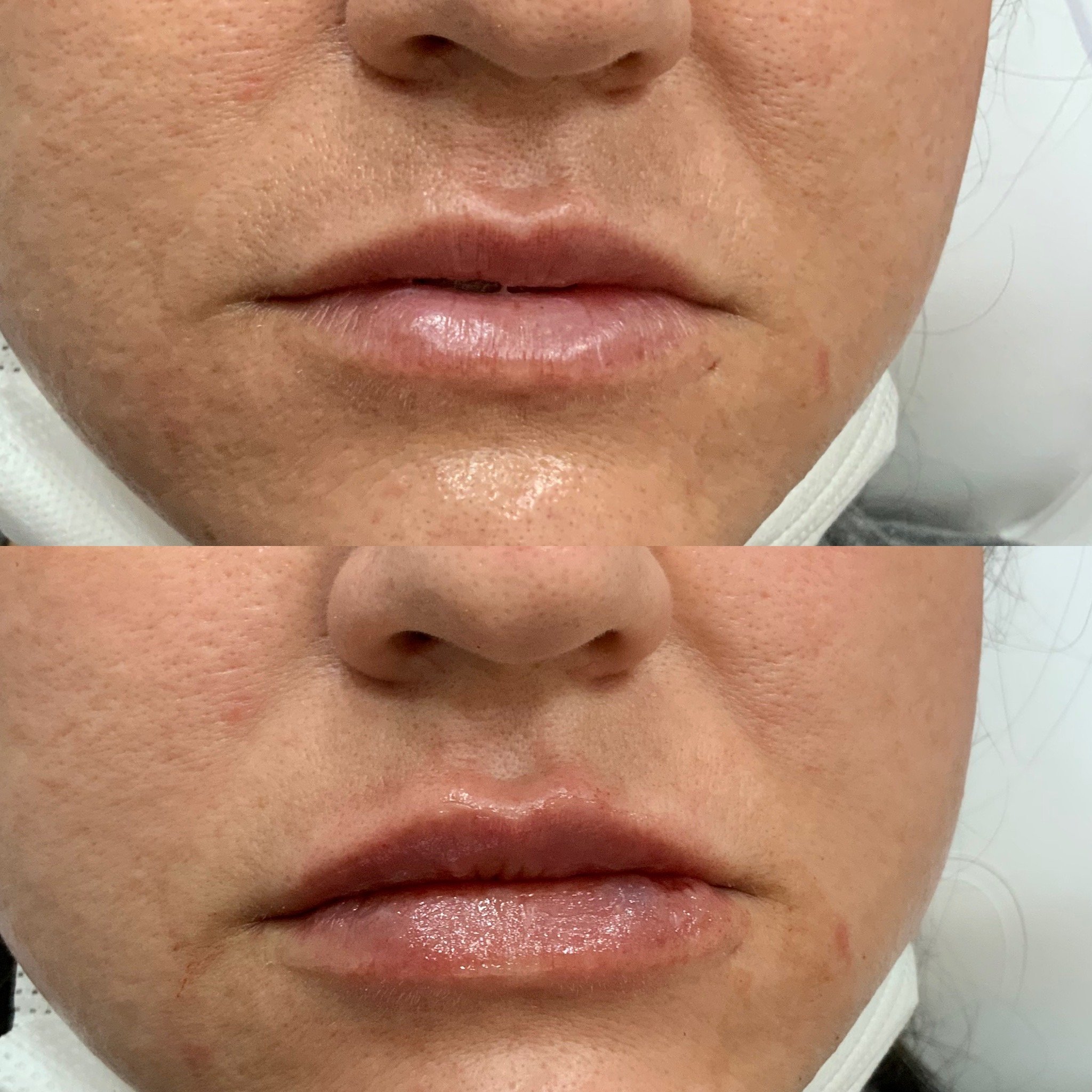 Lip FIller