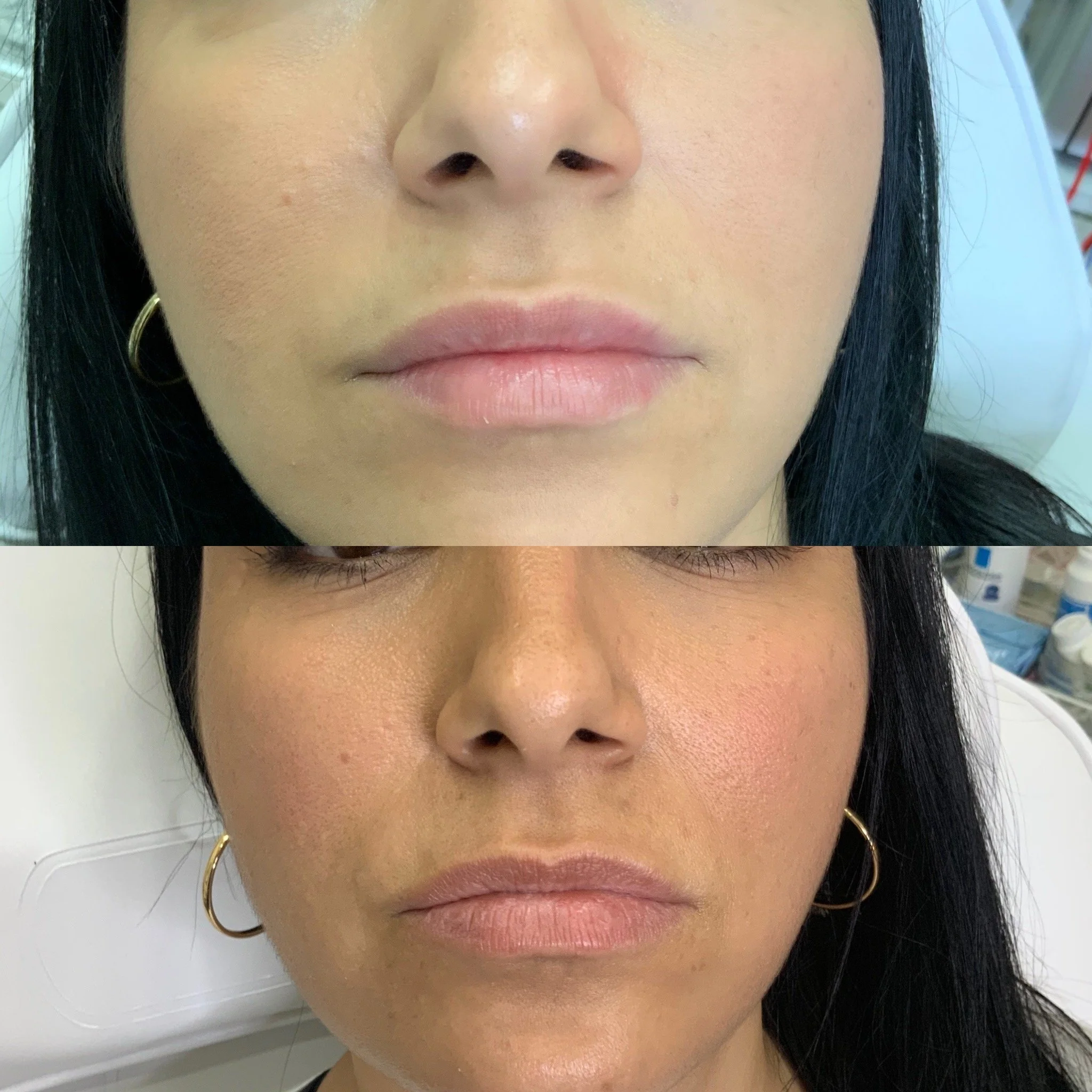 Lip FIller