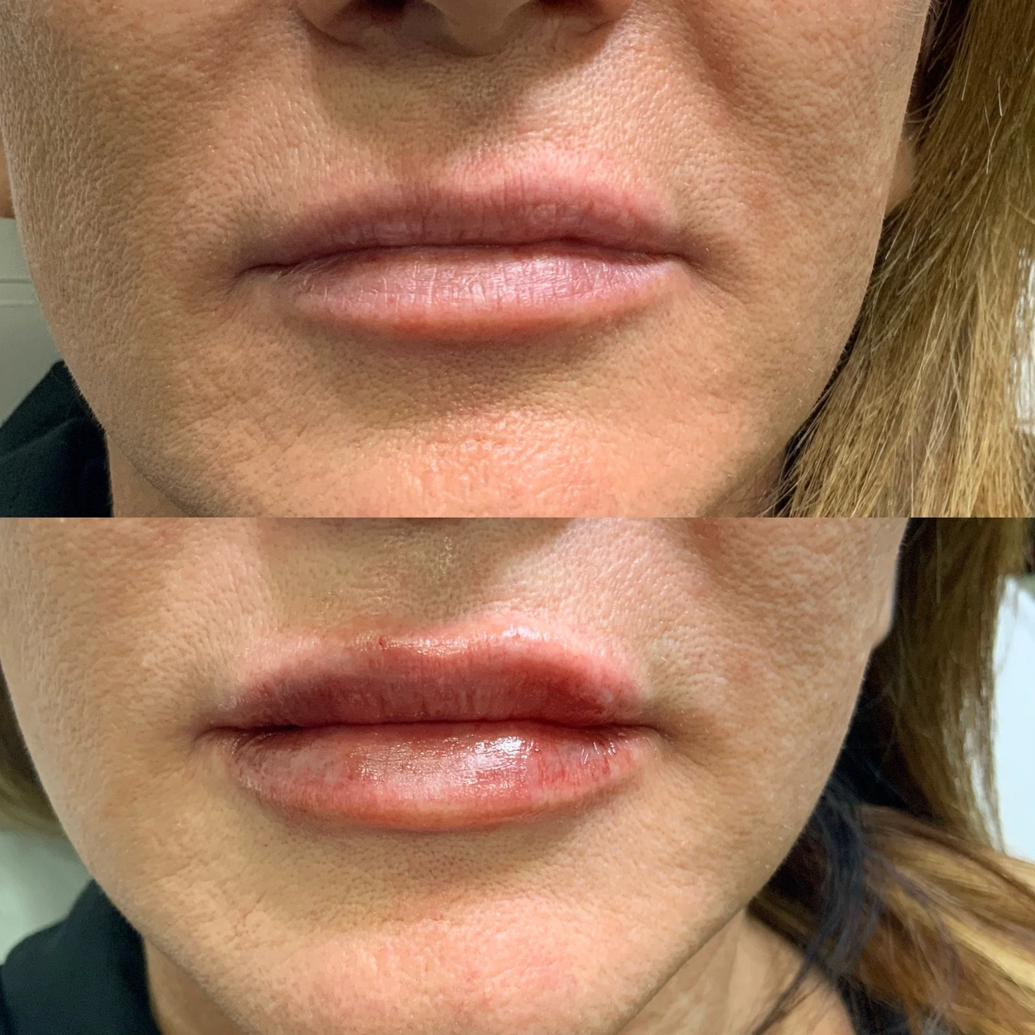 Lip Filler