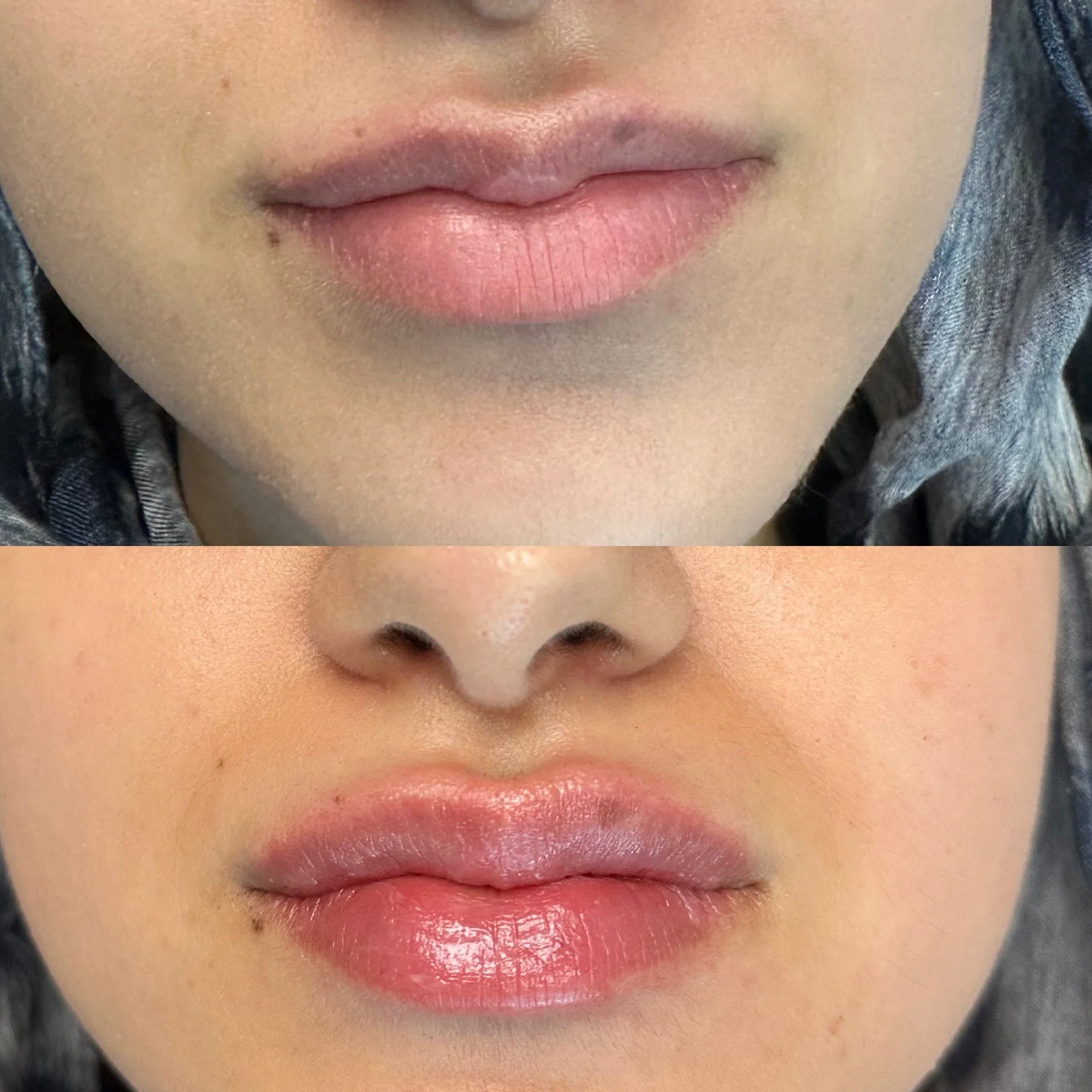 Lip Filler