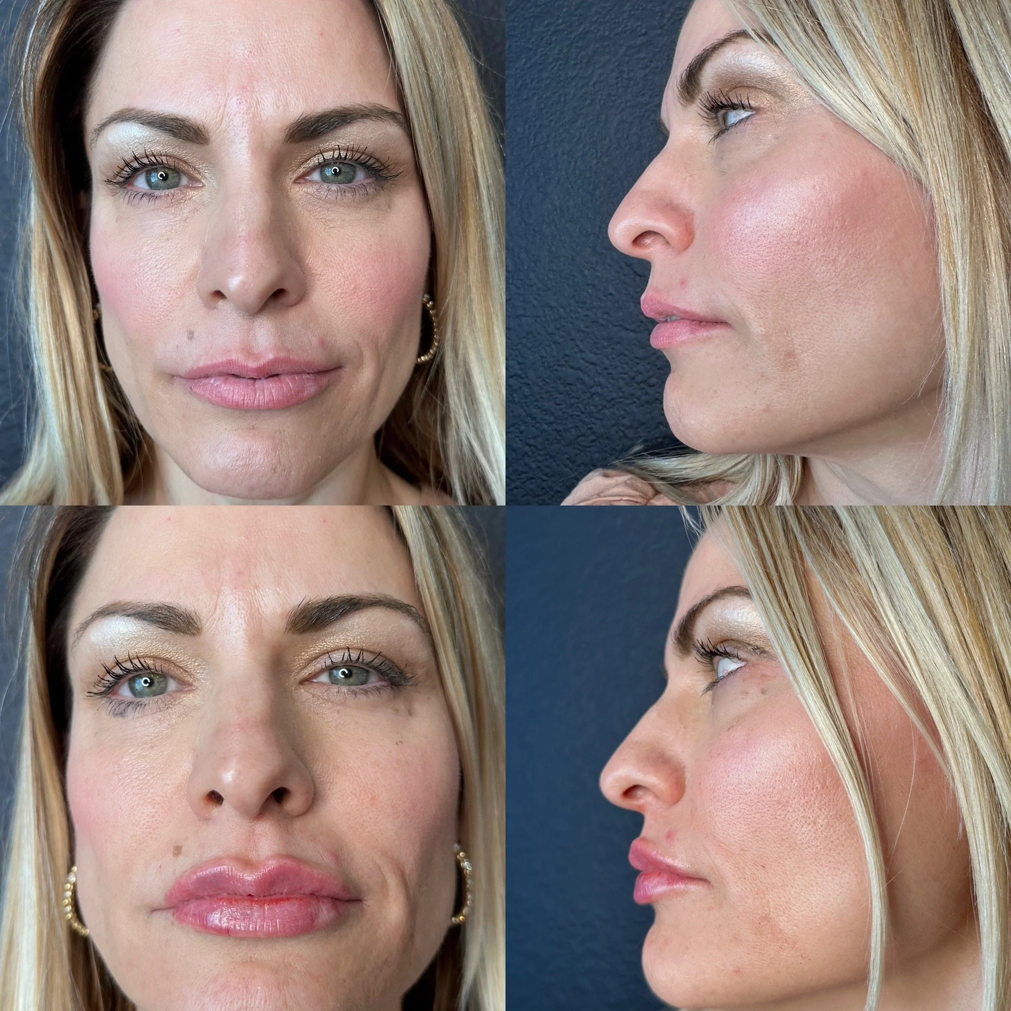 Lip FIller