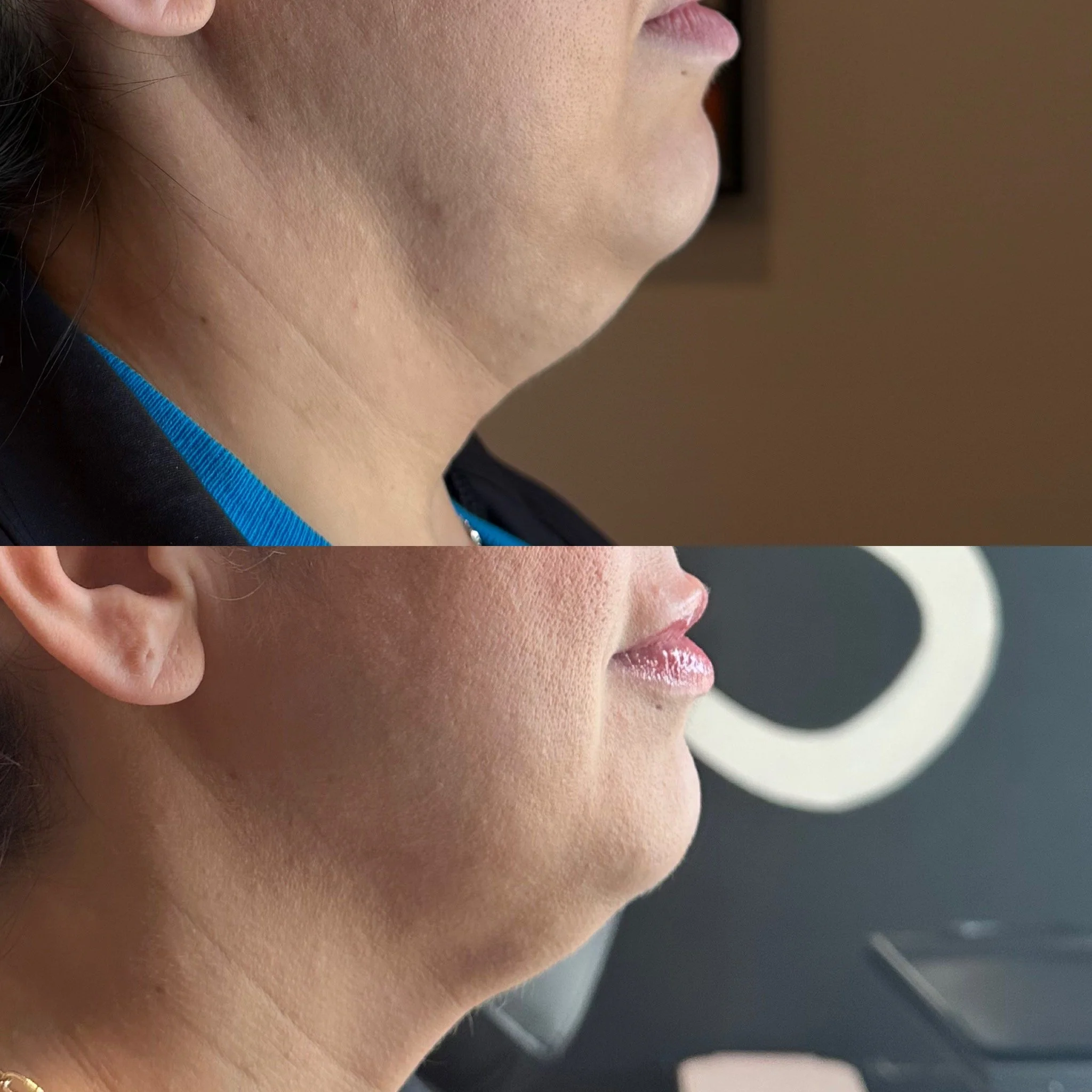fat dissolver pcdc.JPG