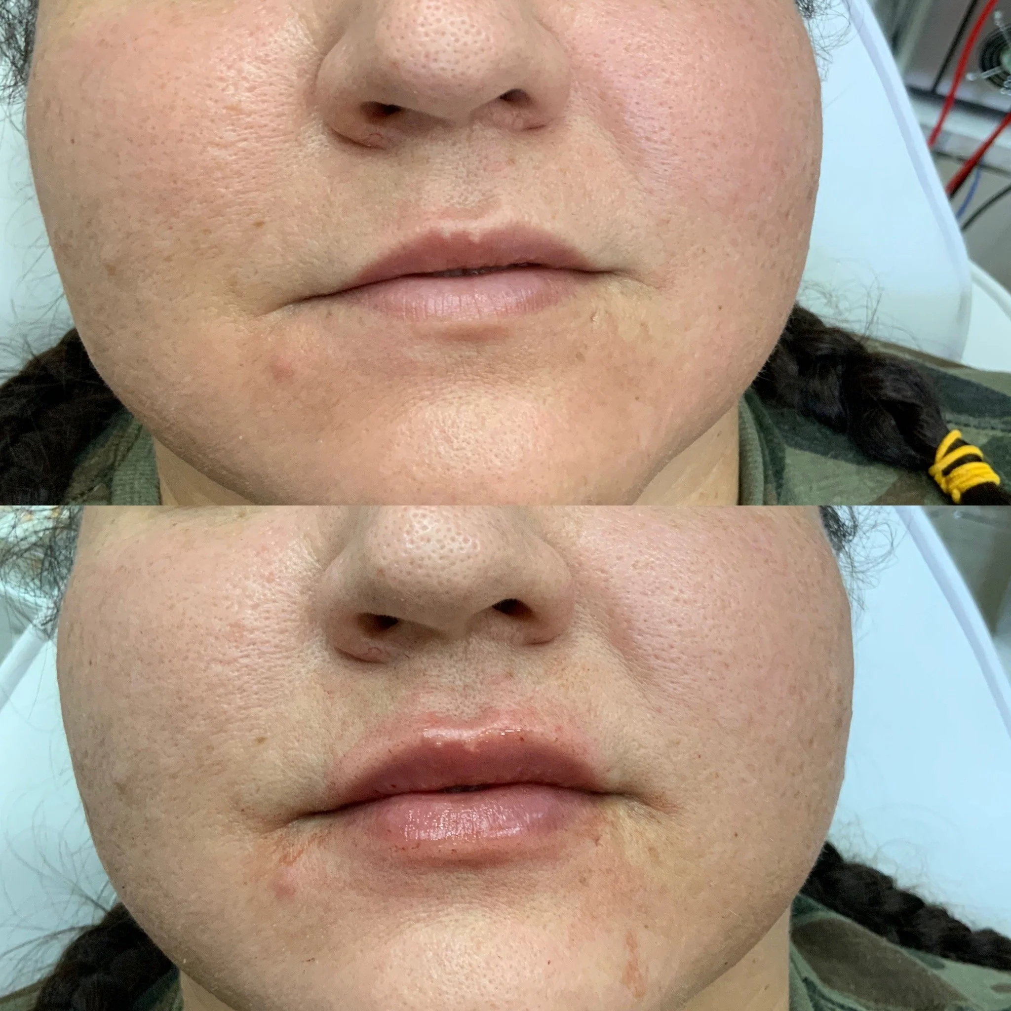 Lip FIller