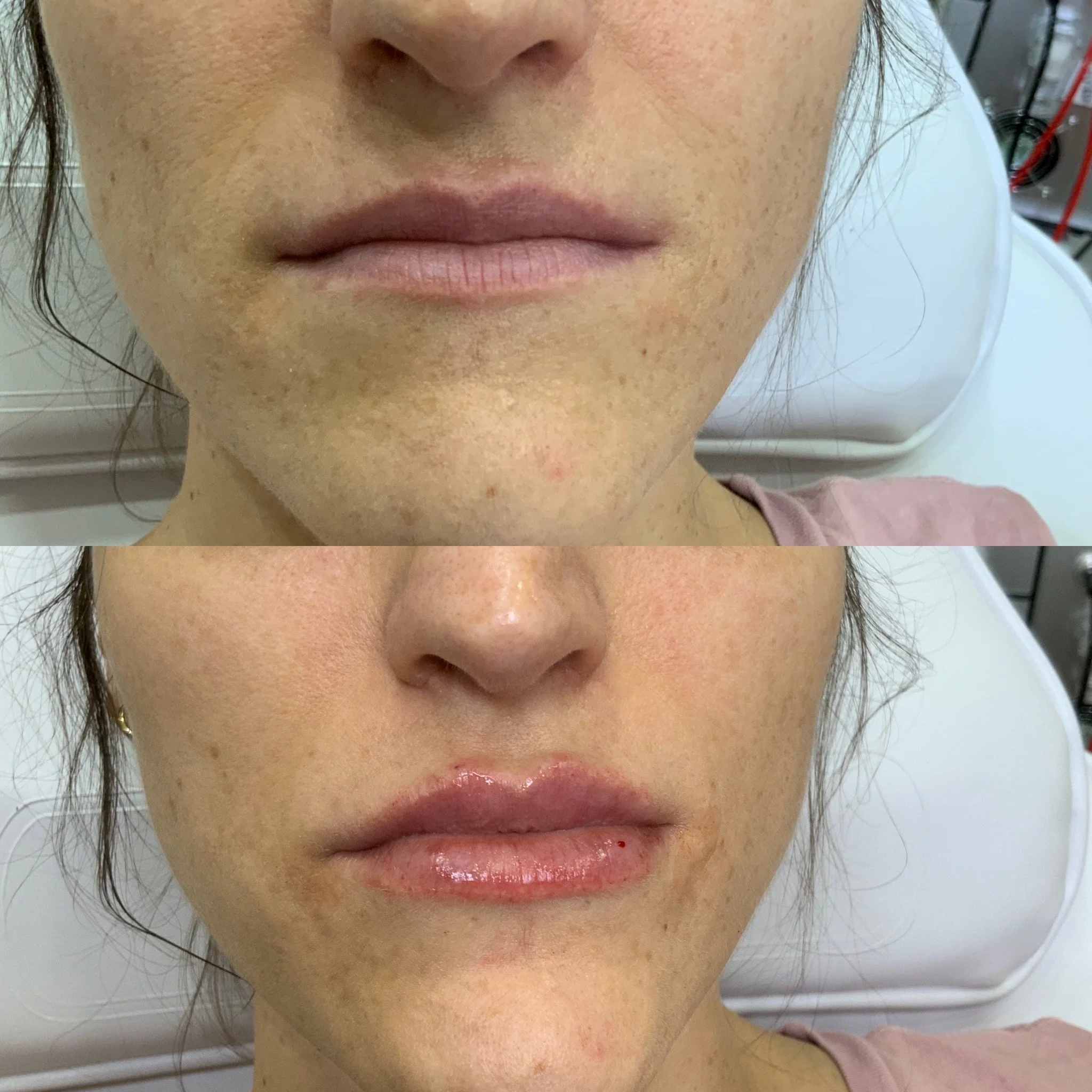 Lip Filler