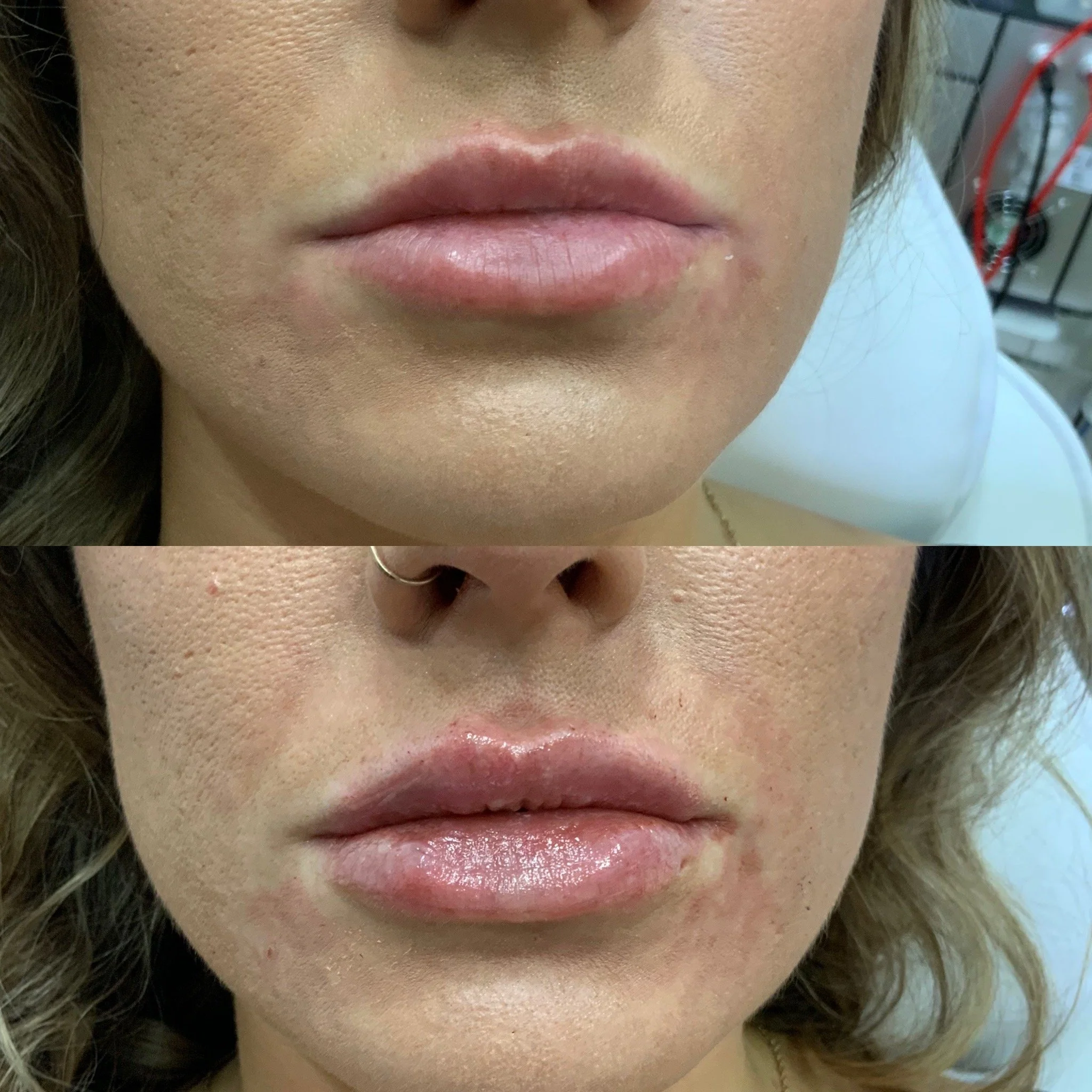 Lip FIller