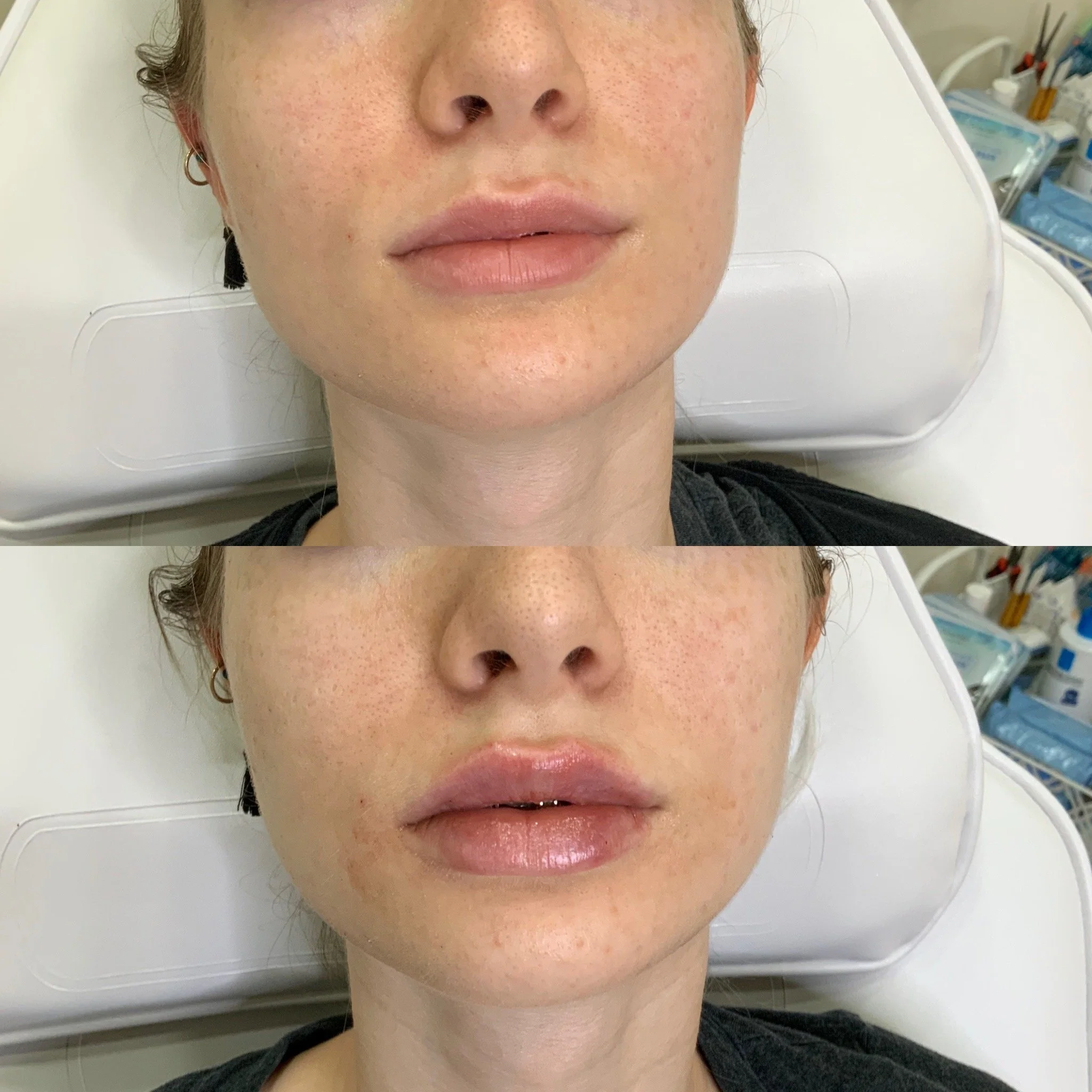 Lip FIller