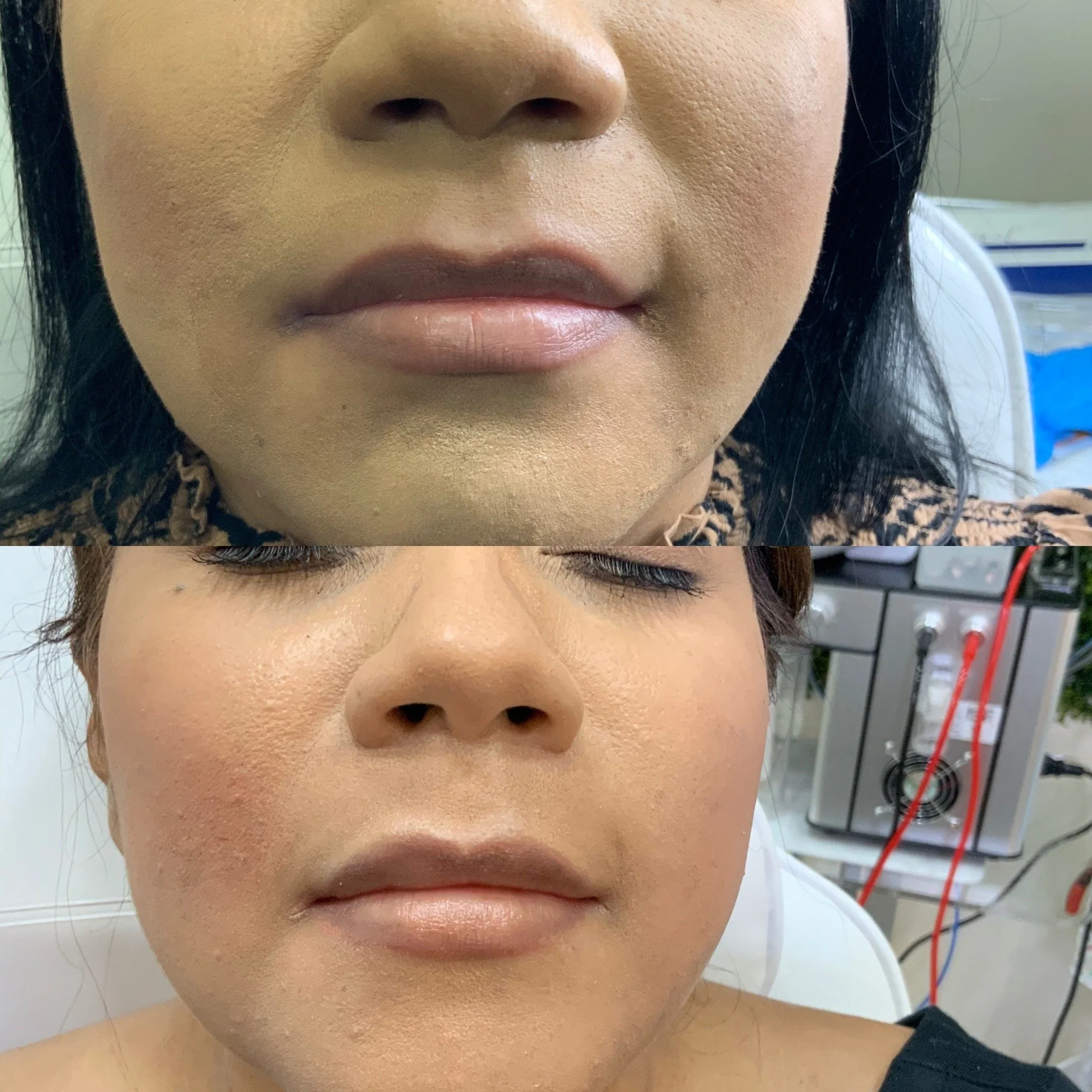 Lip Filler