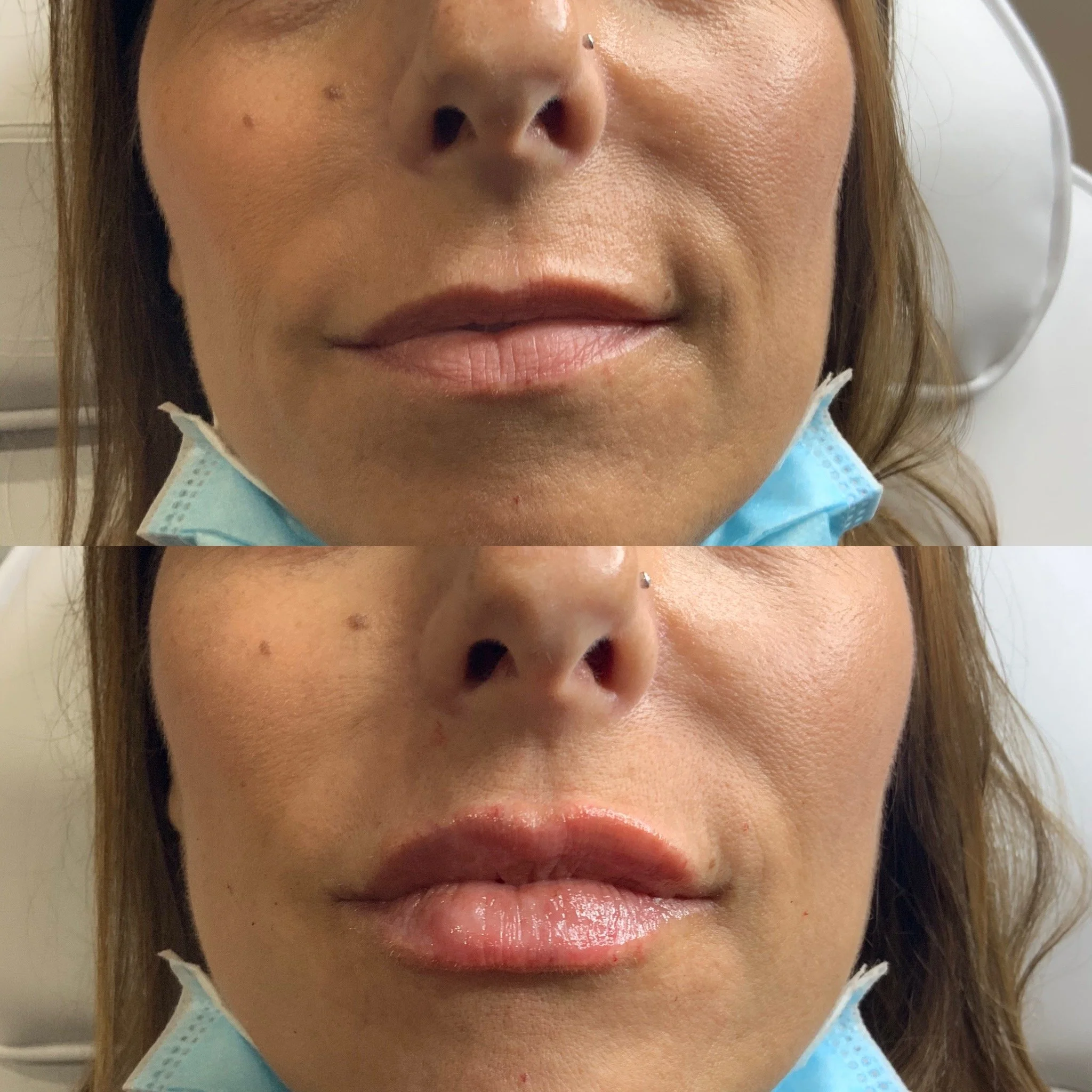 Lip FIller