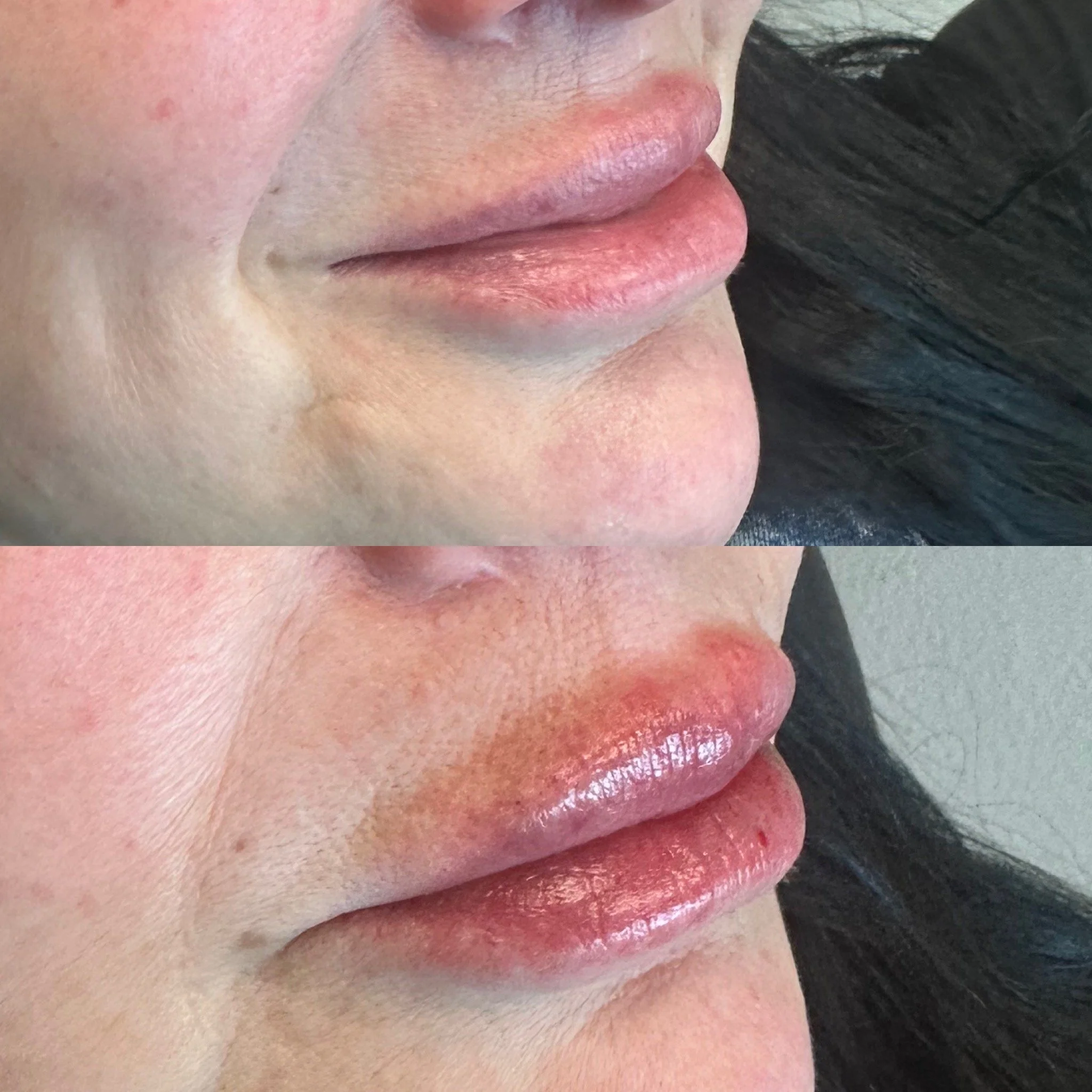 Lip Filler- Injecting around lip implant 