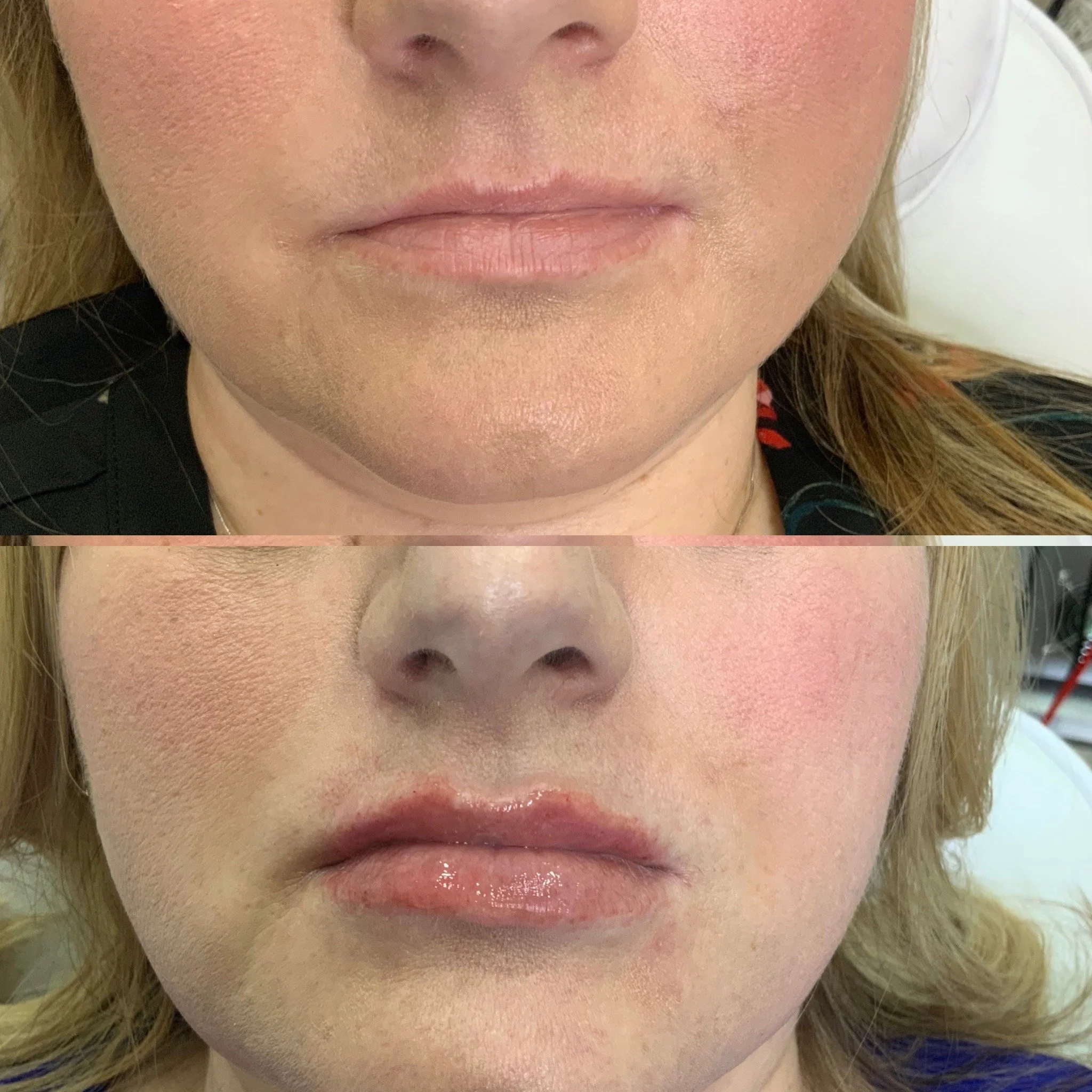 Lip Filler