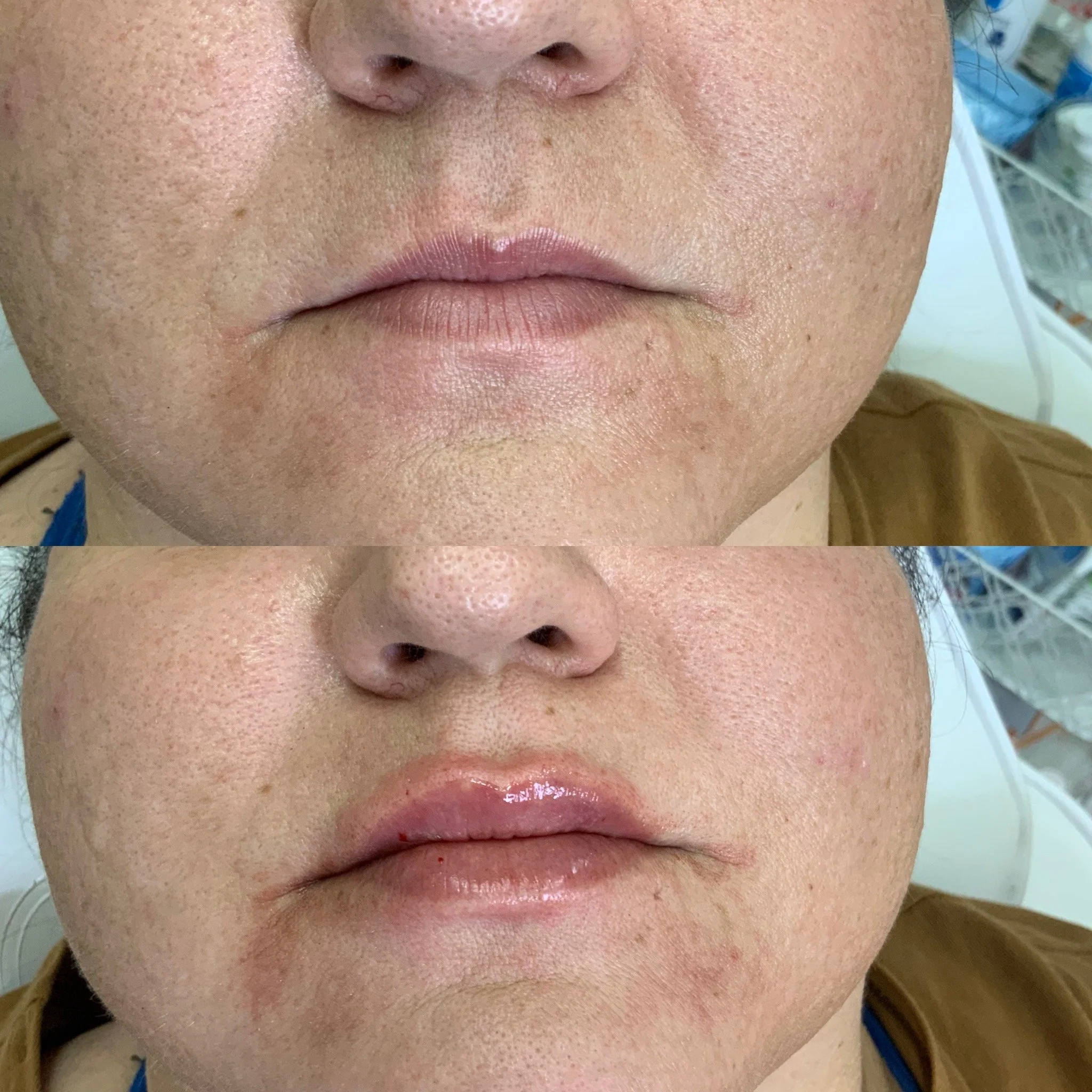 Lip FIller