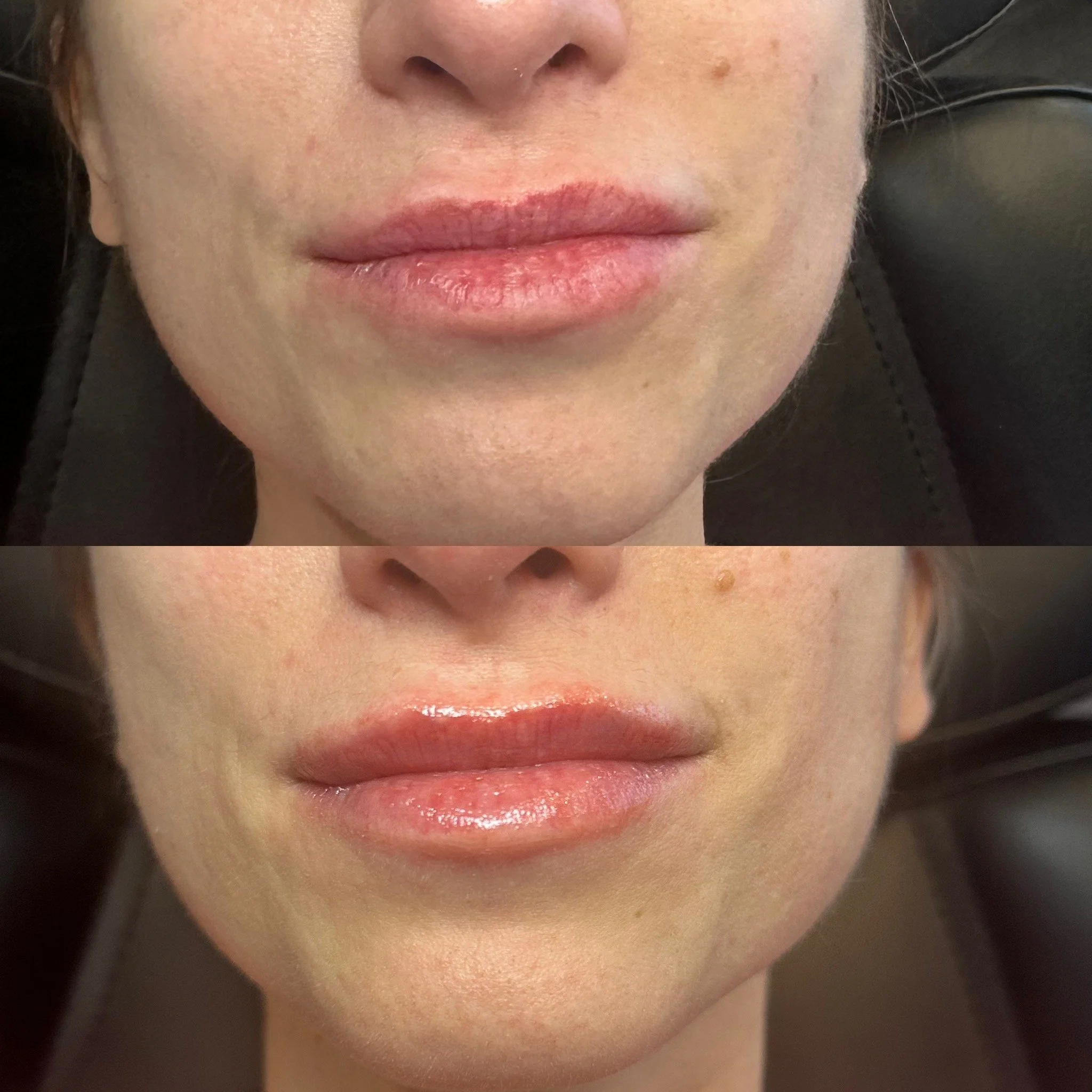 Lip Filler