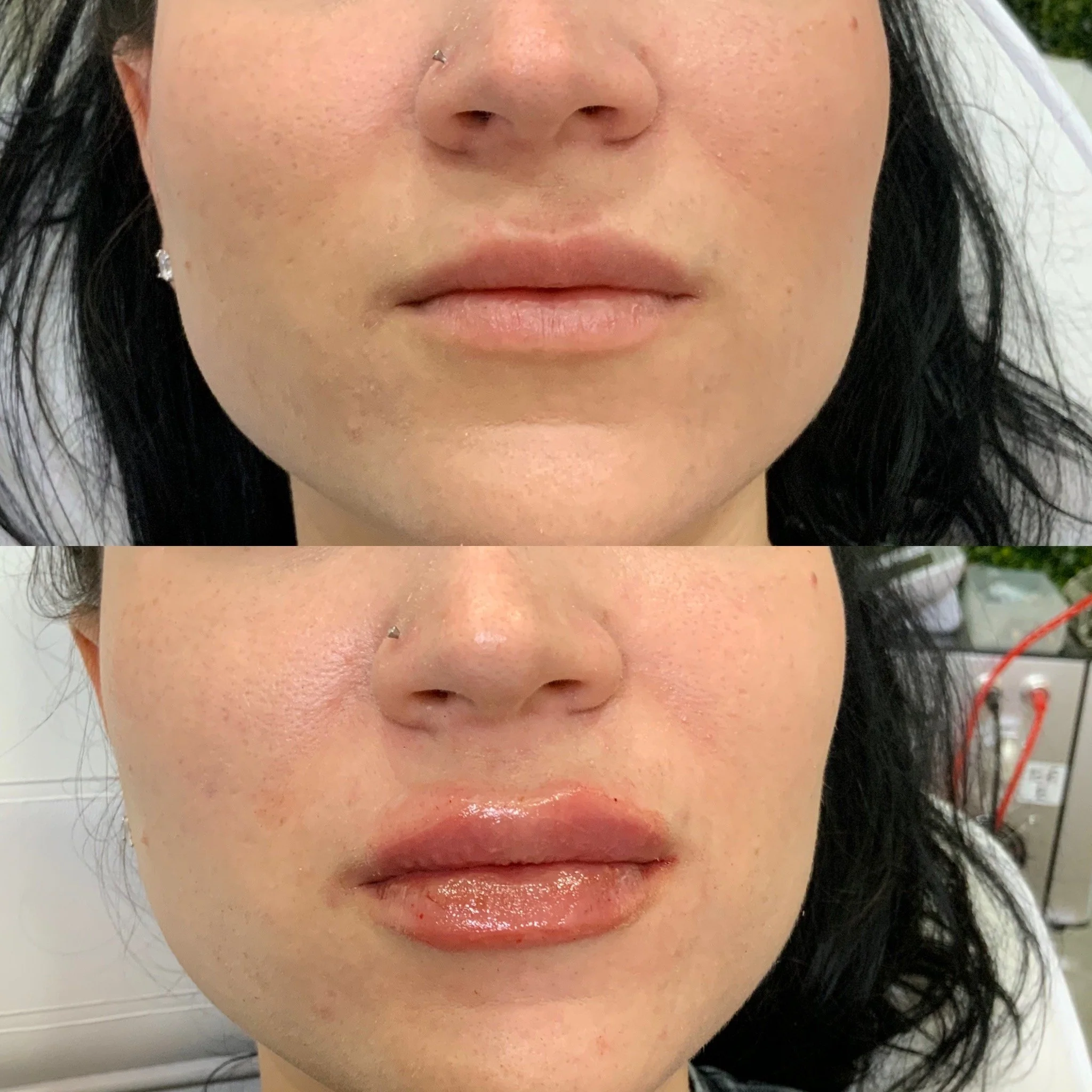 Lip FIller