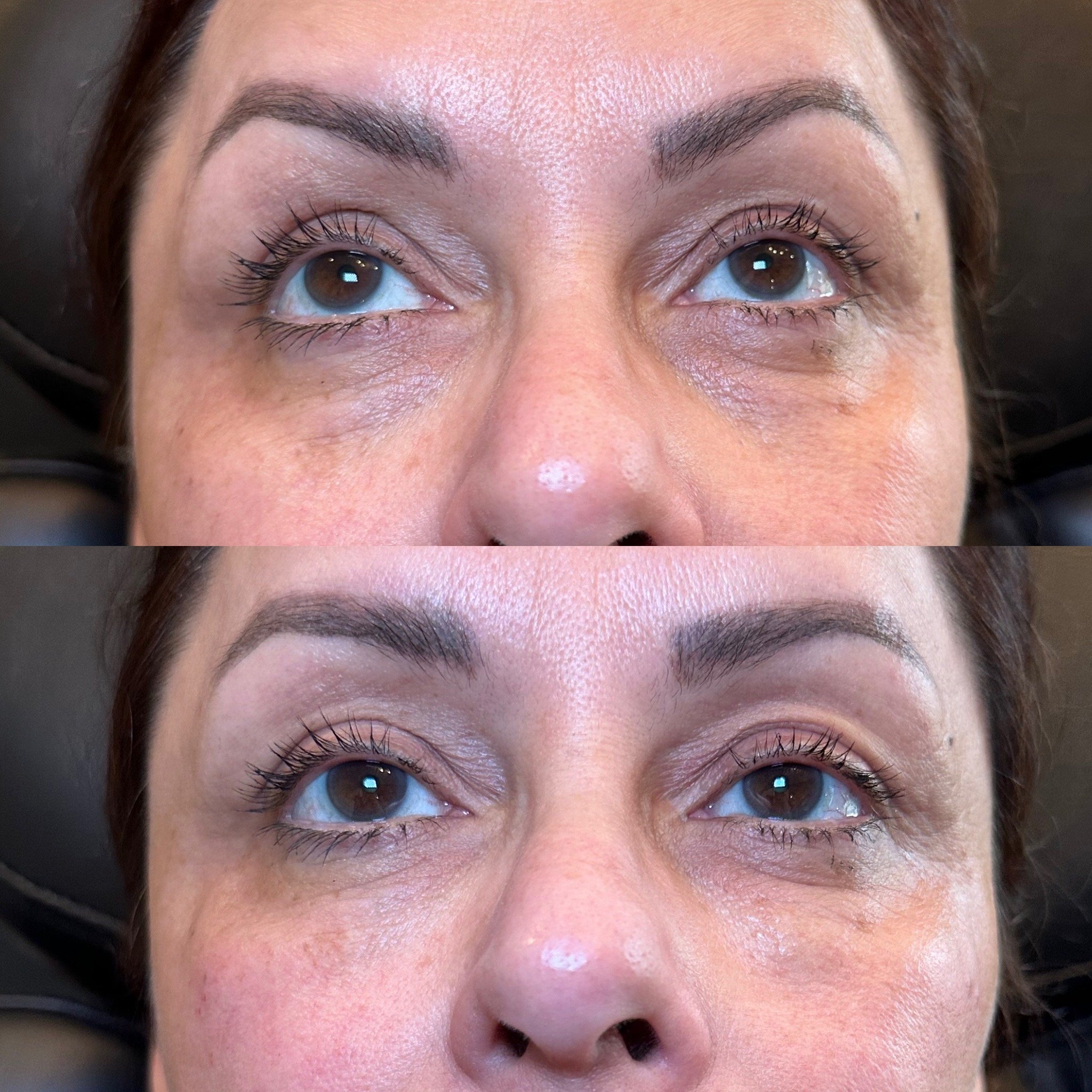 under eye bio filler.JPG (Copy)