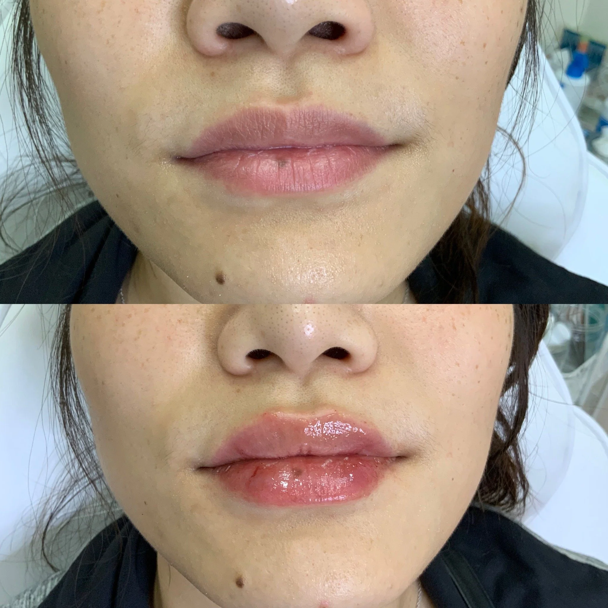 Lip FIller