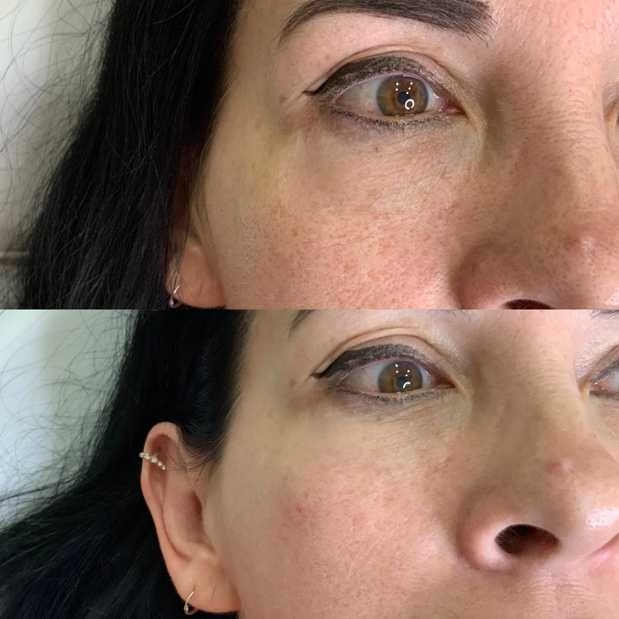 Under Eye Treatment