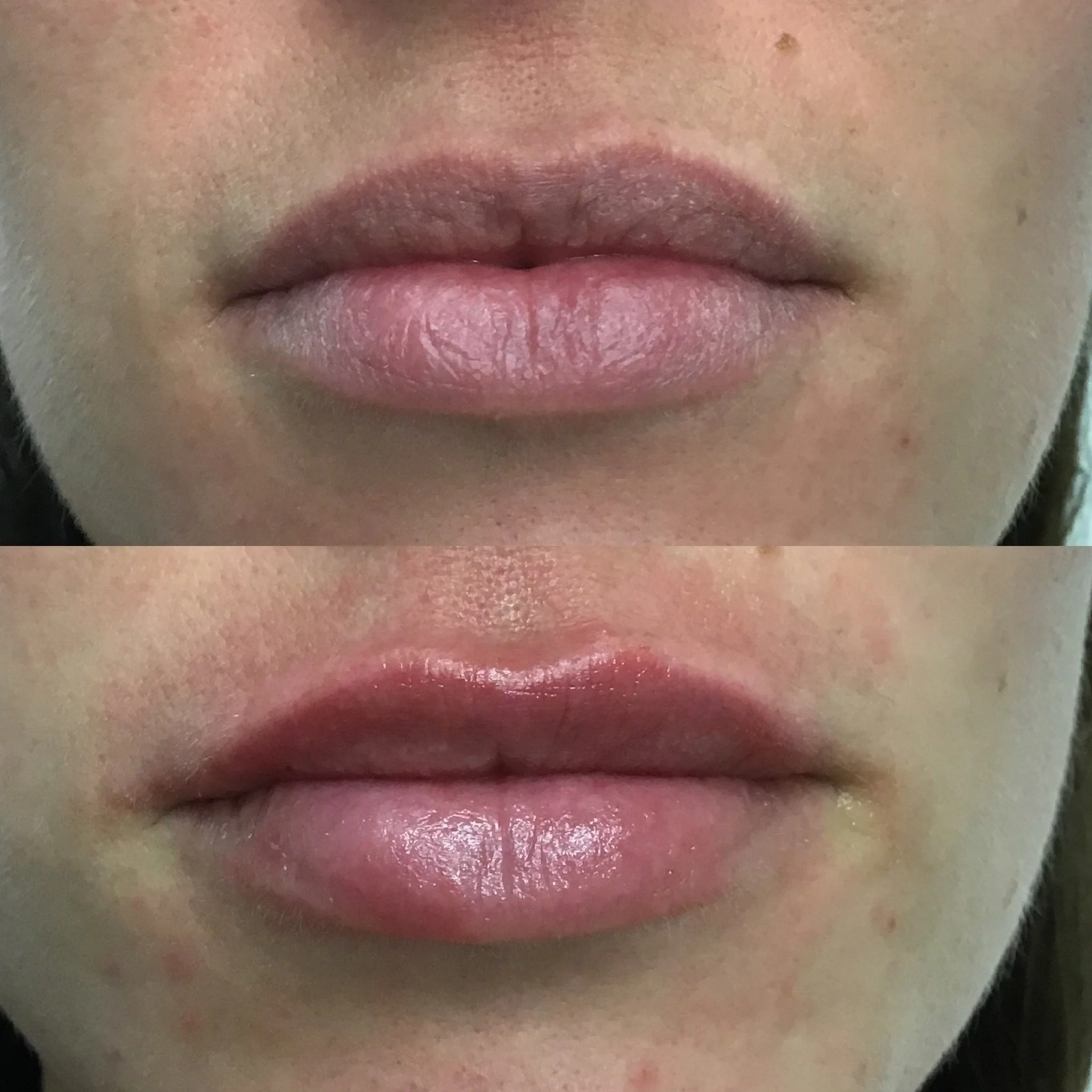 Lip Filler