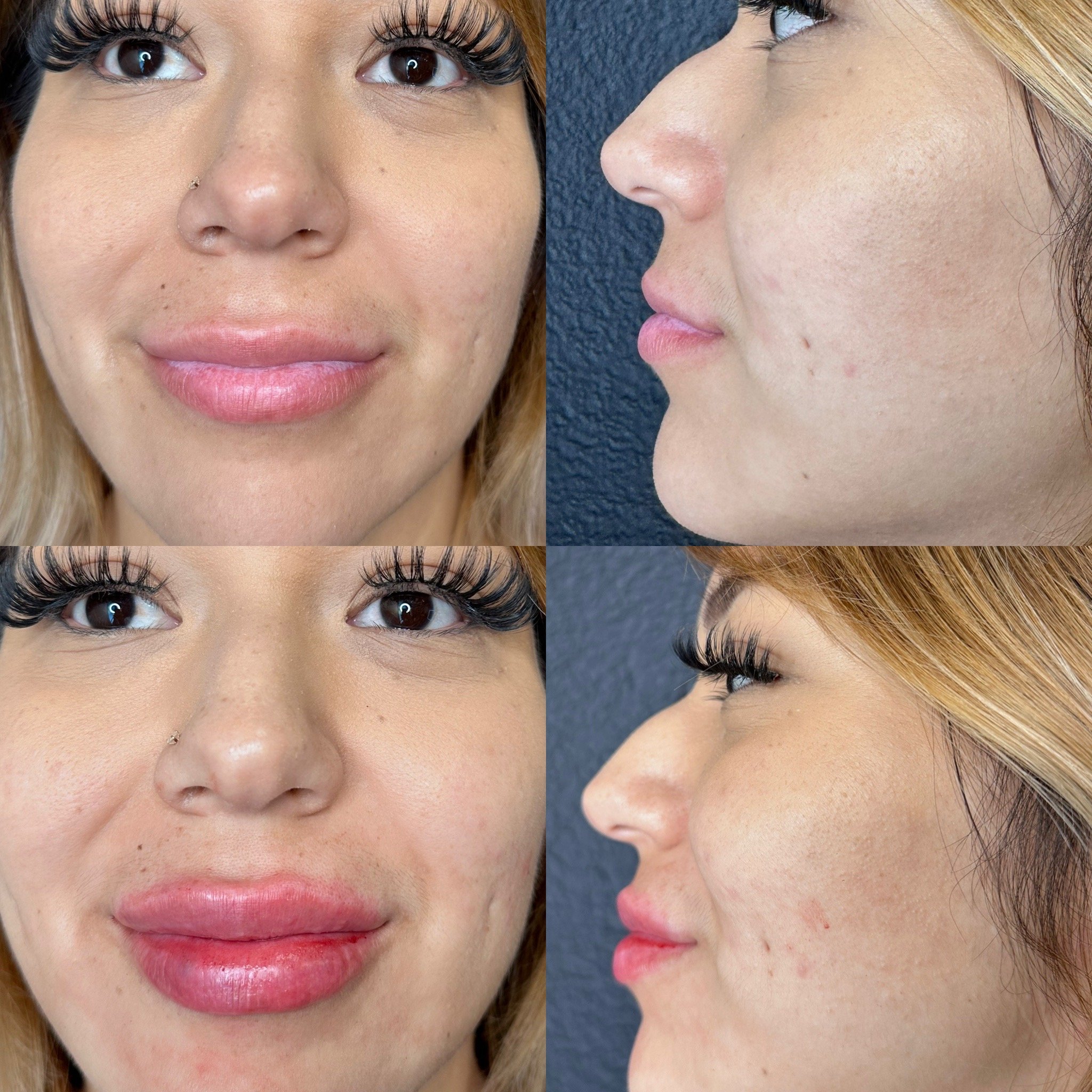 Lip Filler