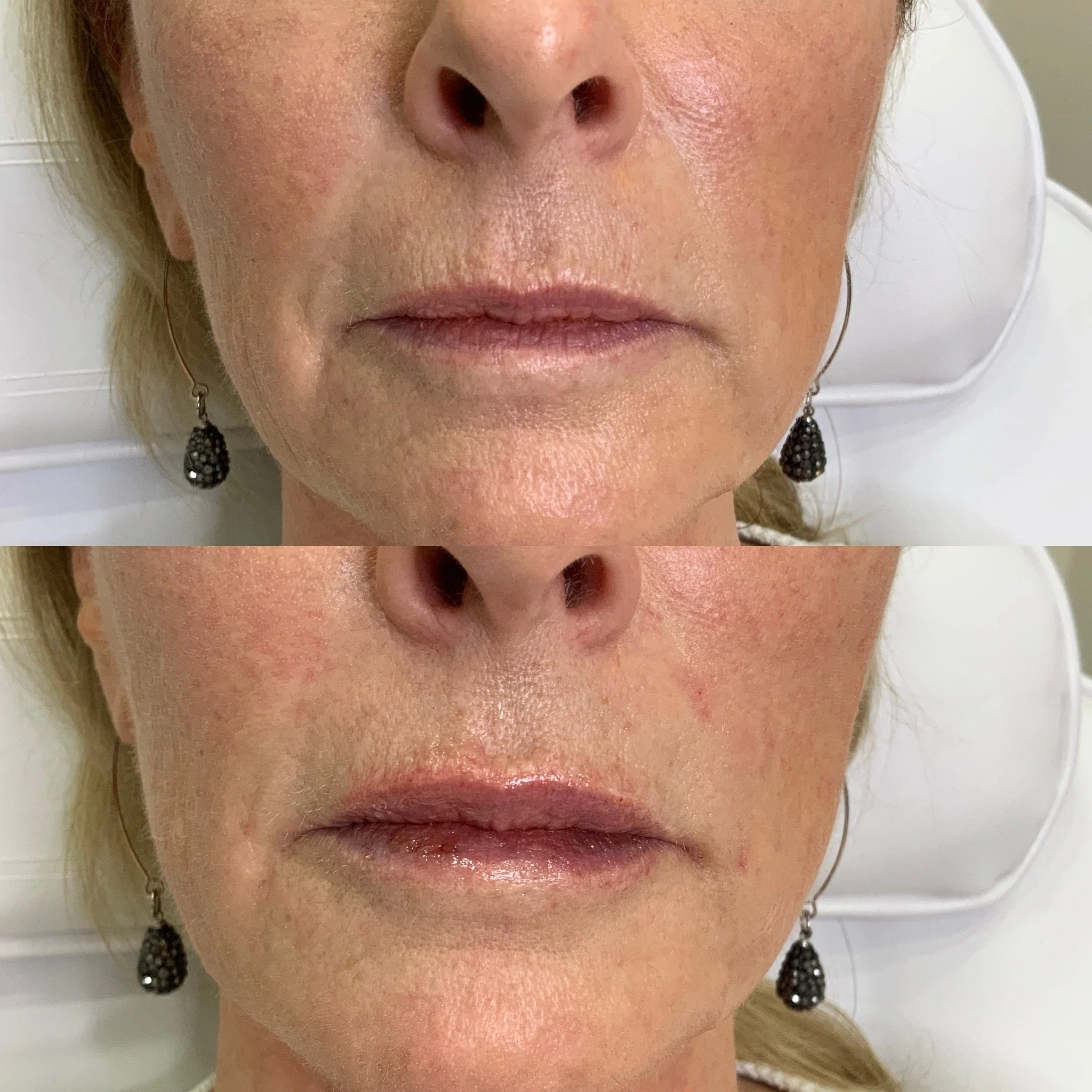 Smile Line Filler and Lip Filler