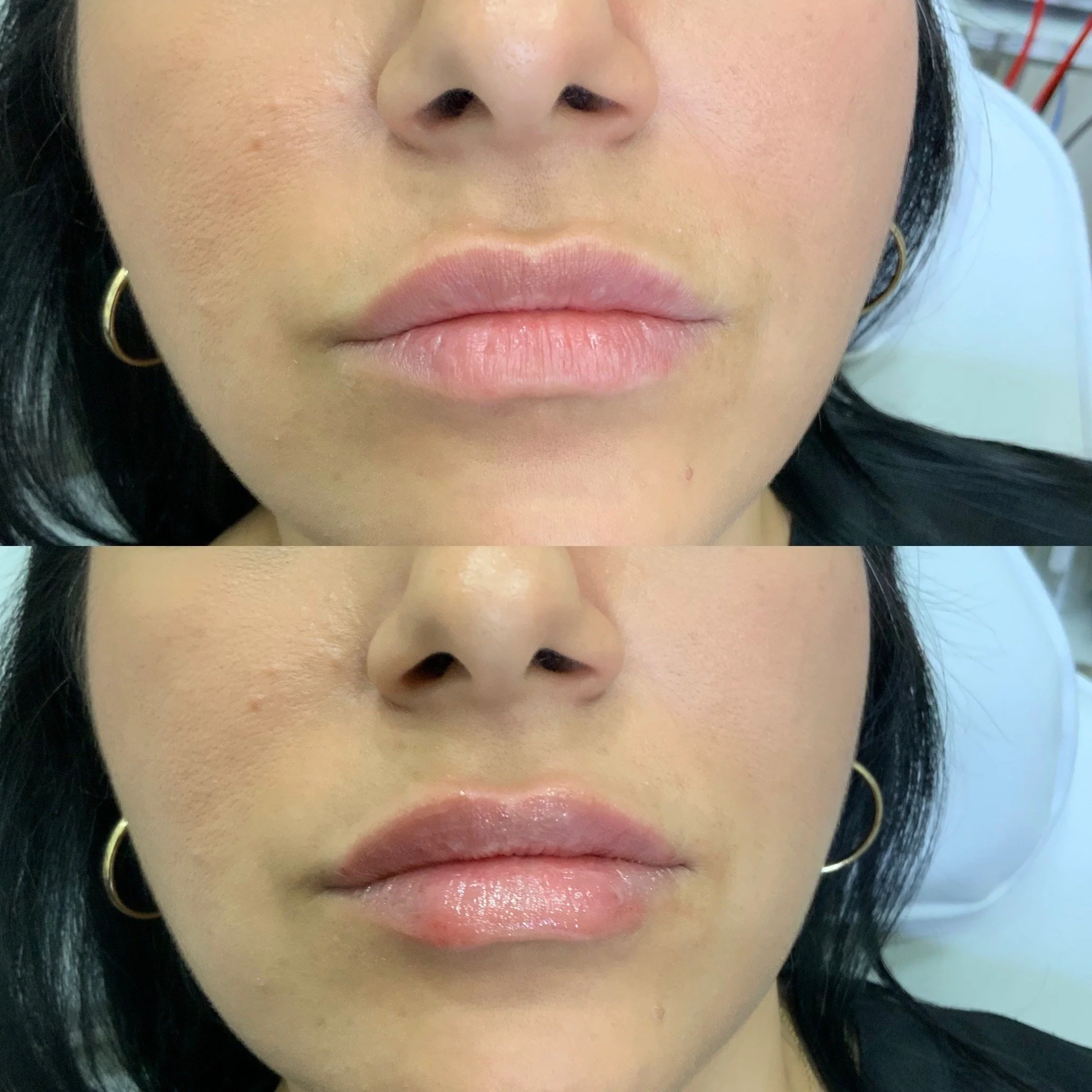 Lip FIller
