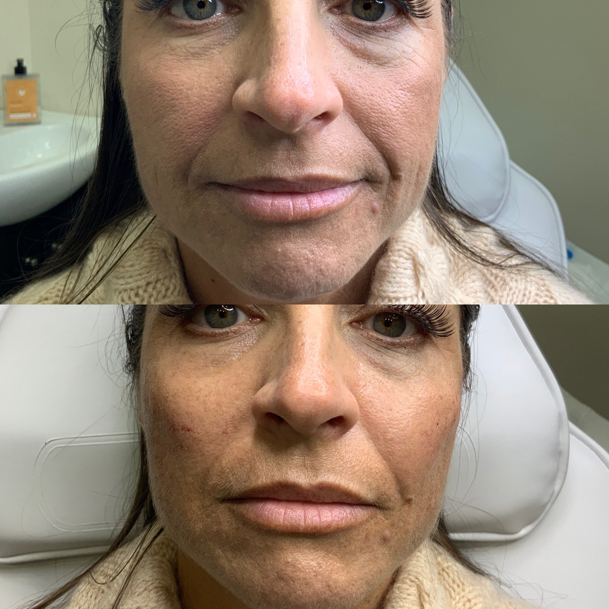 Cheek Filler