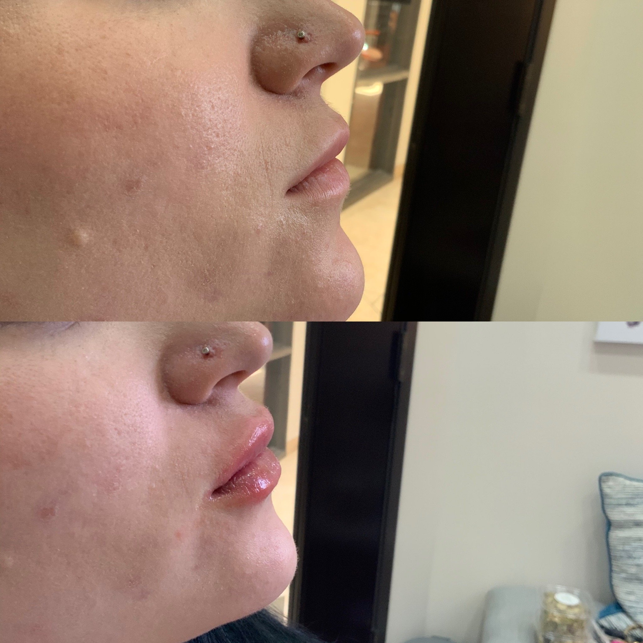 Lip FIller