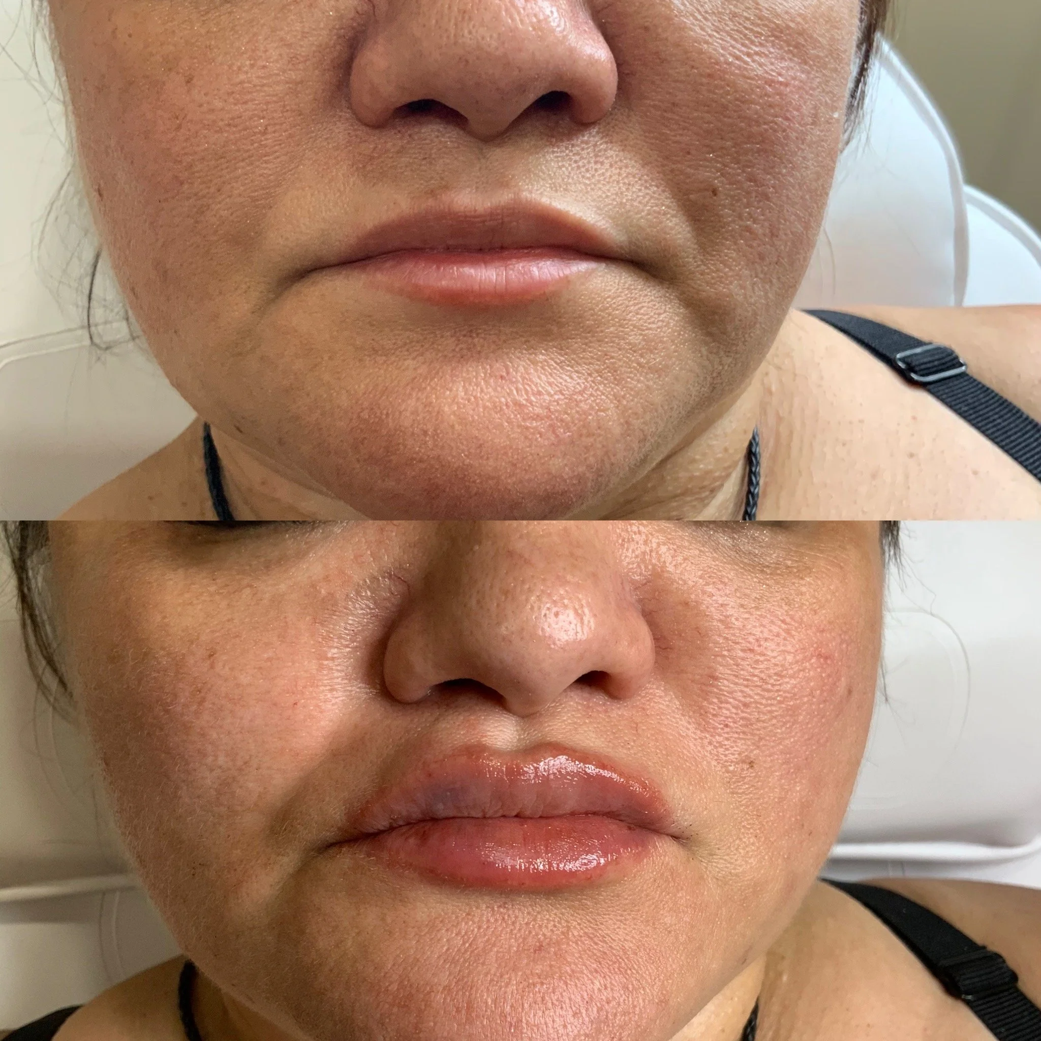 Lip FIller