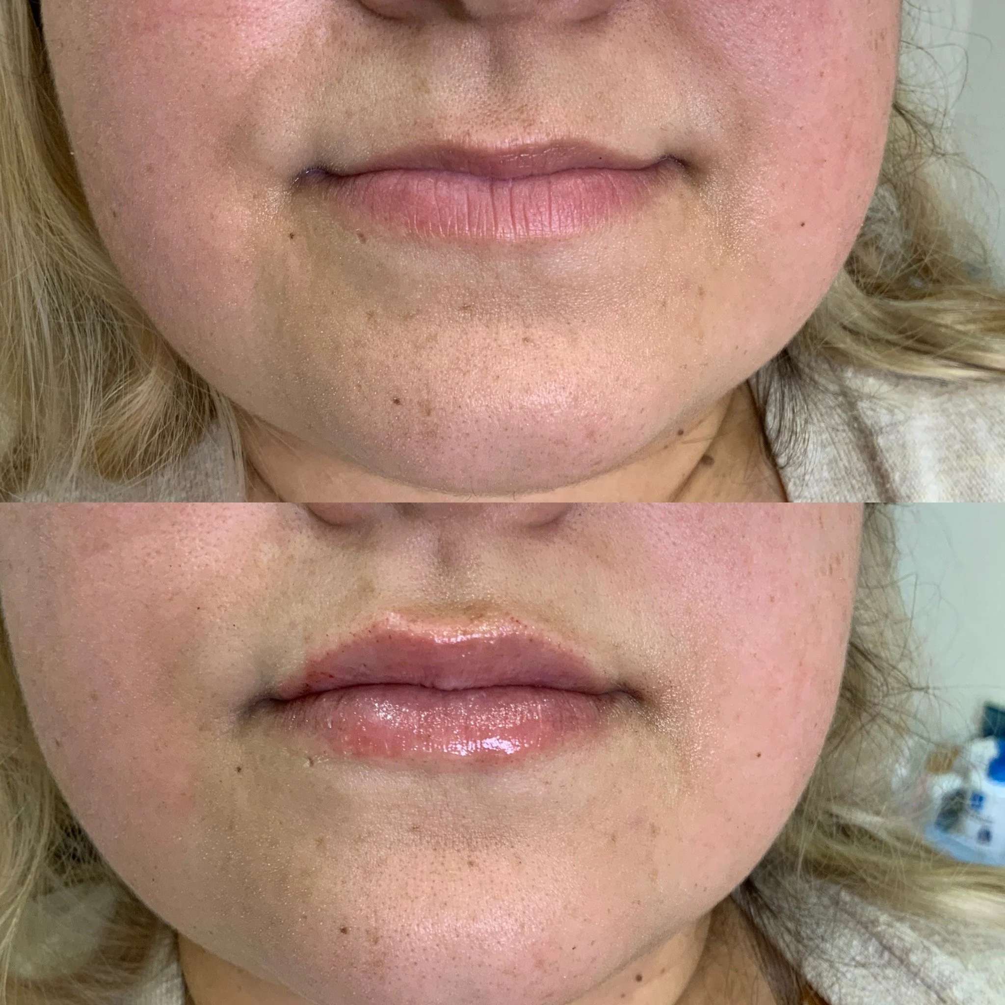 Lip FIller