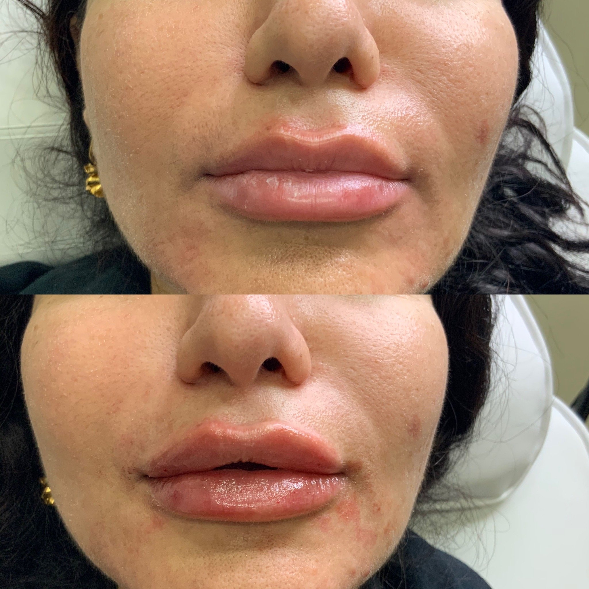 Lip Filler