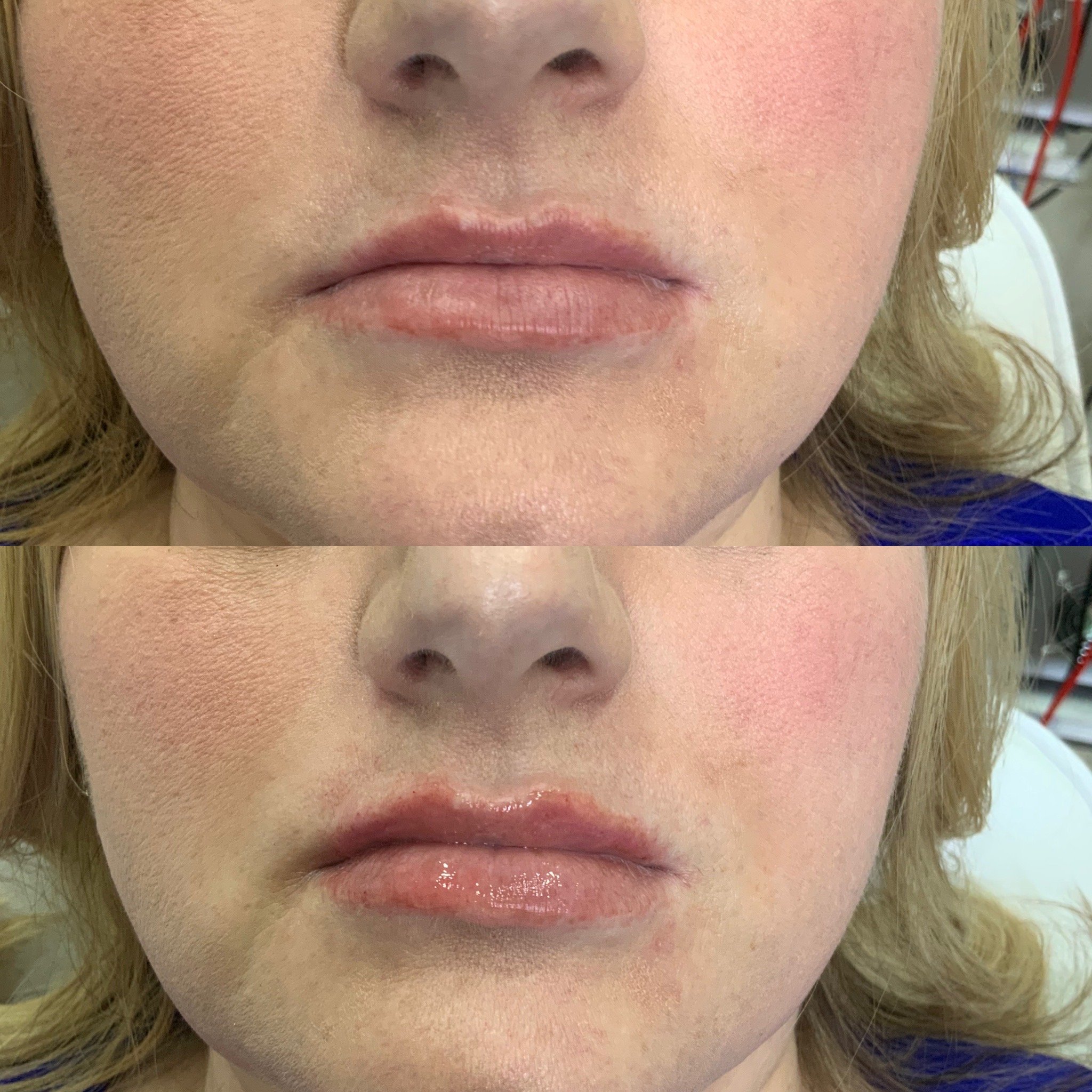 Lip filler.JPG