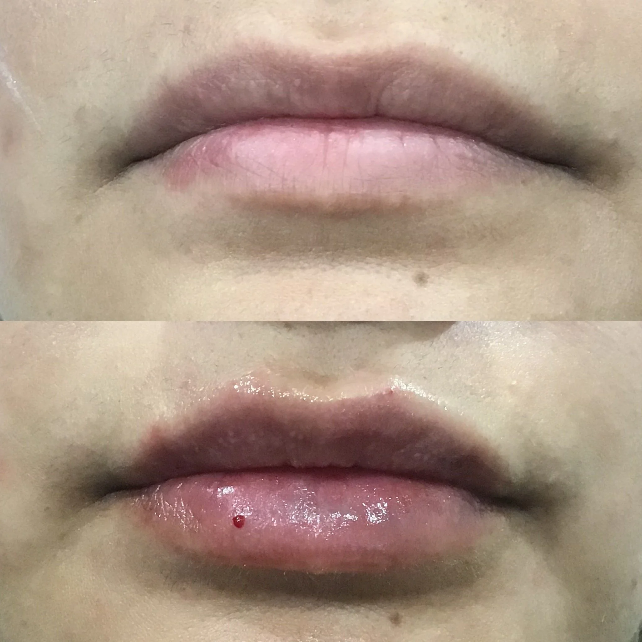 Lip Filler
