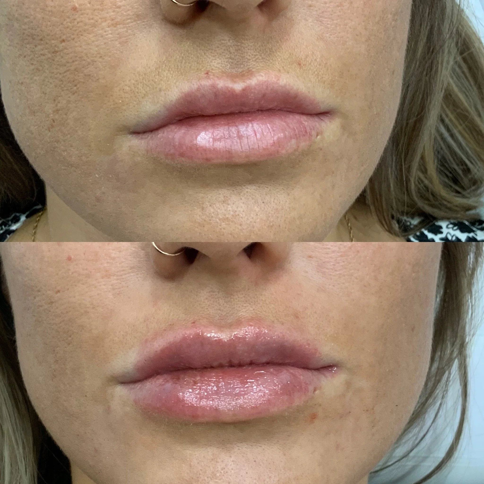 Lip FIller