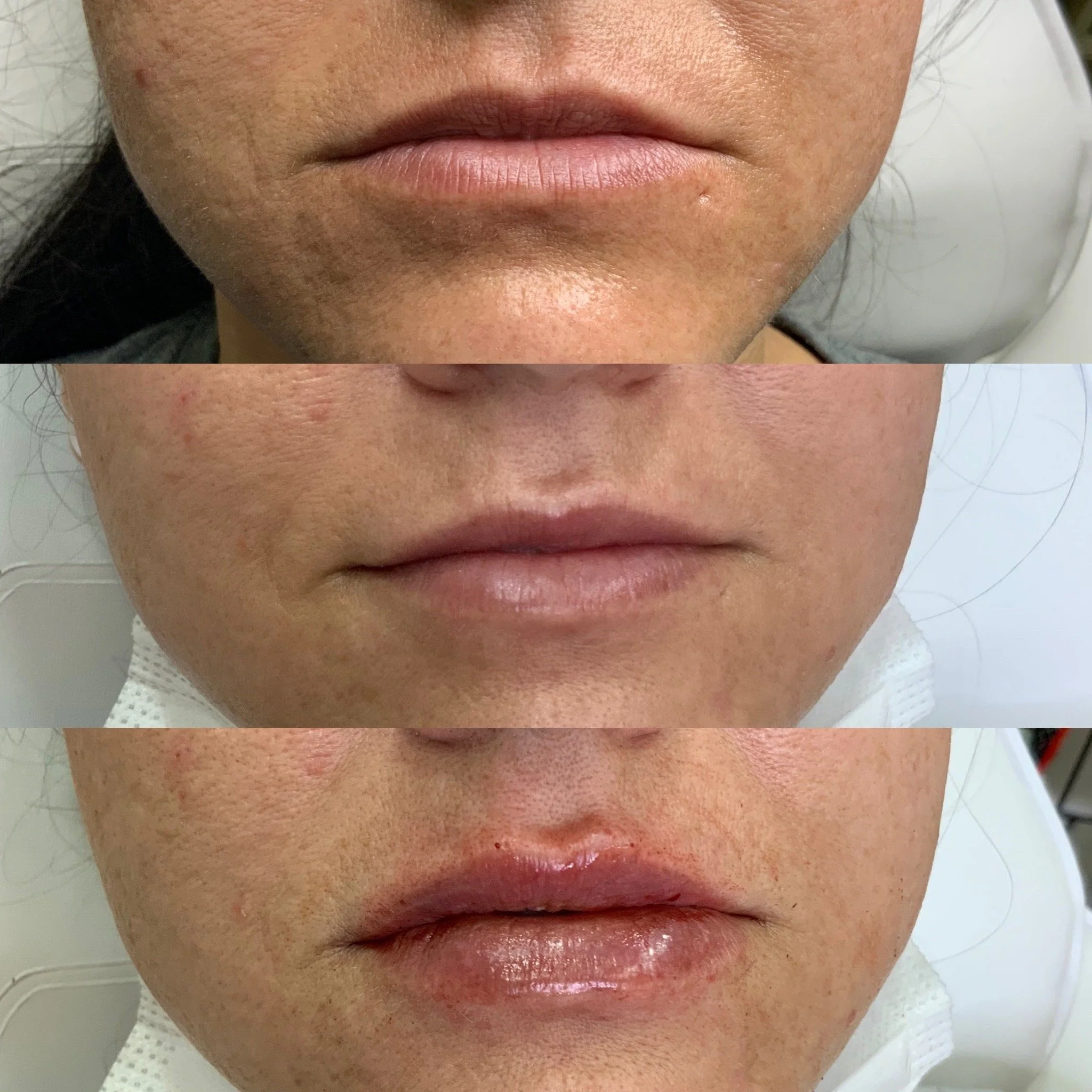 Lip Filler building over multiple sessions