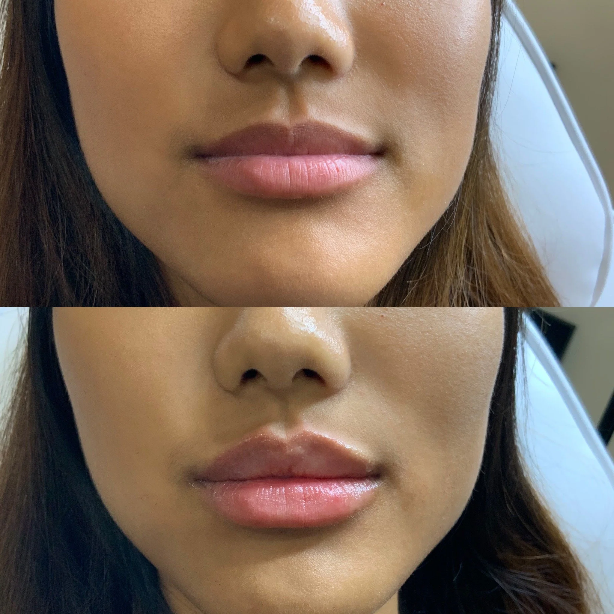 Lip FIller