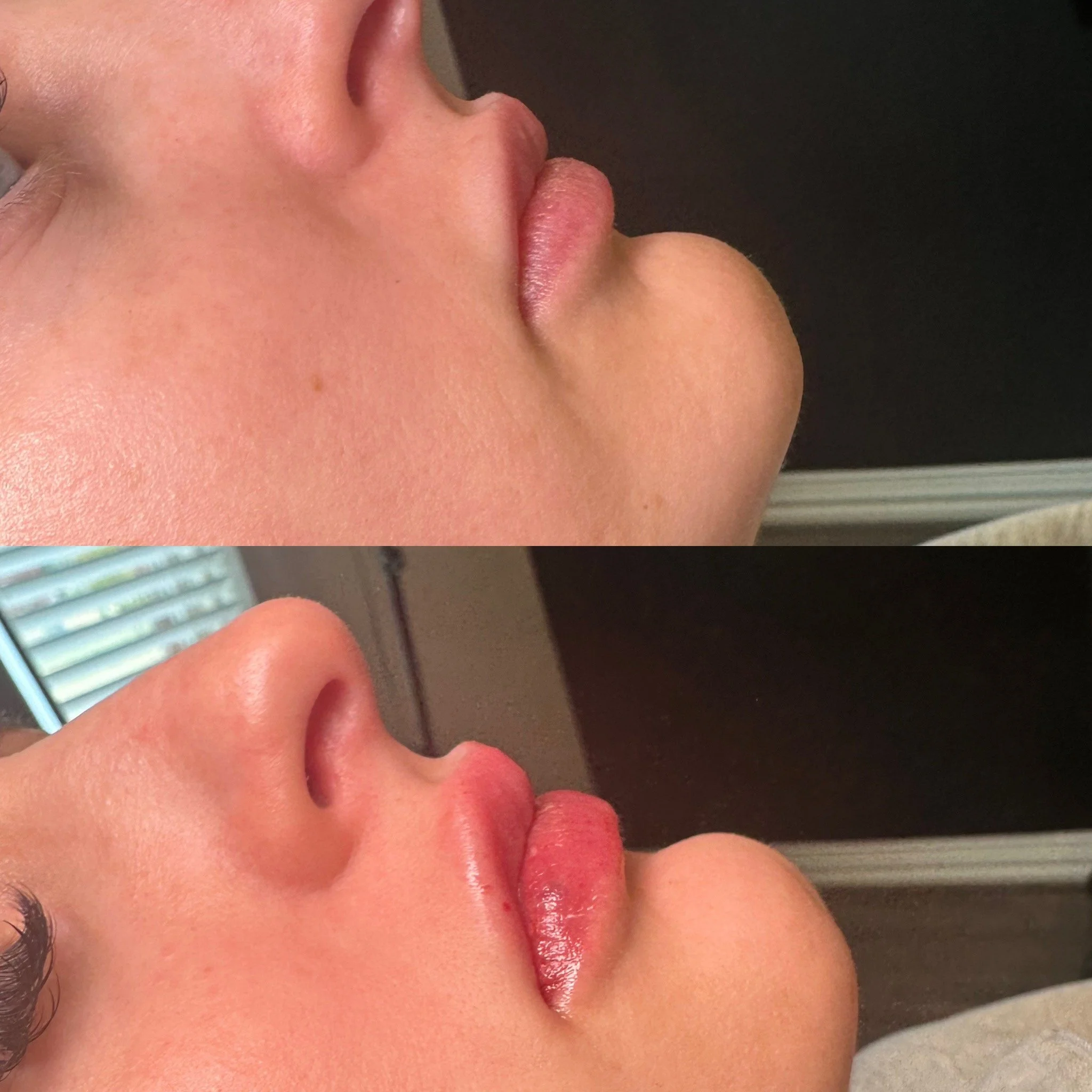Lip Filler