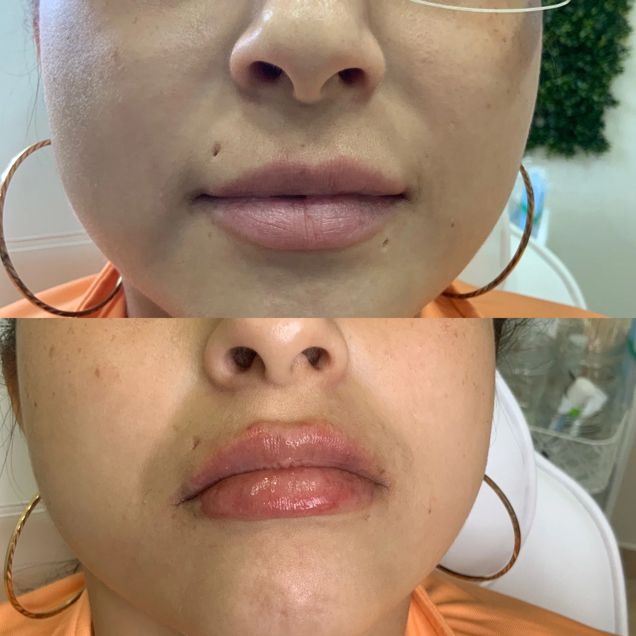 Lip FIller