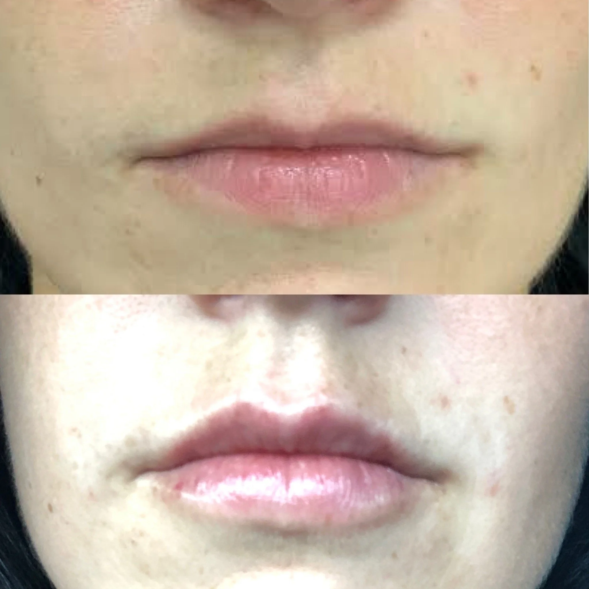 Lip Filler