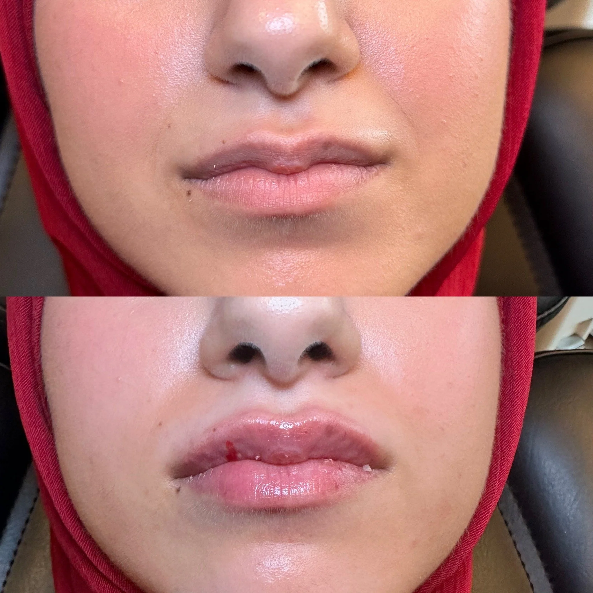 Lip Filler- M shapre lip