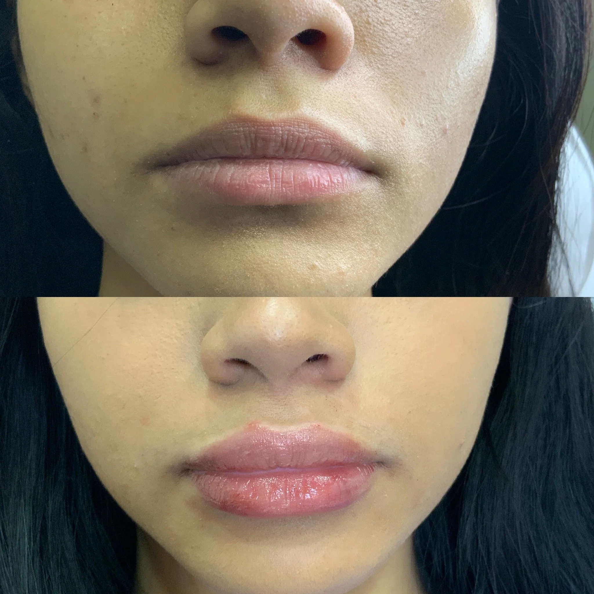 Lip FIller
