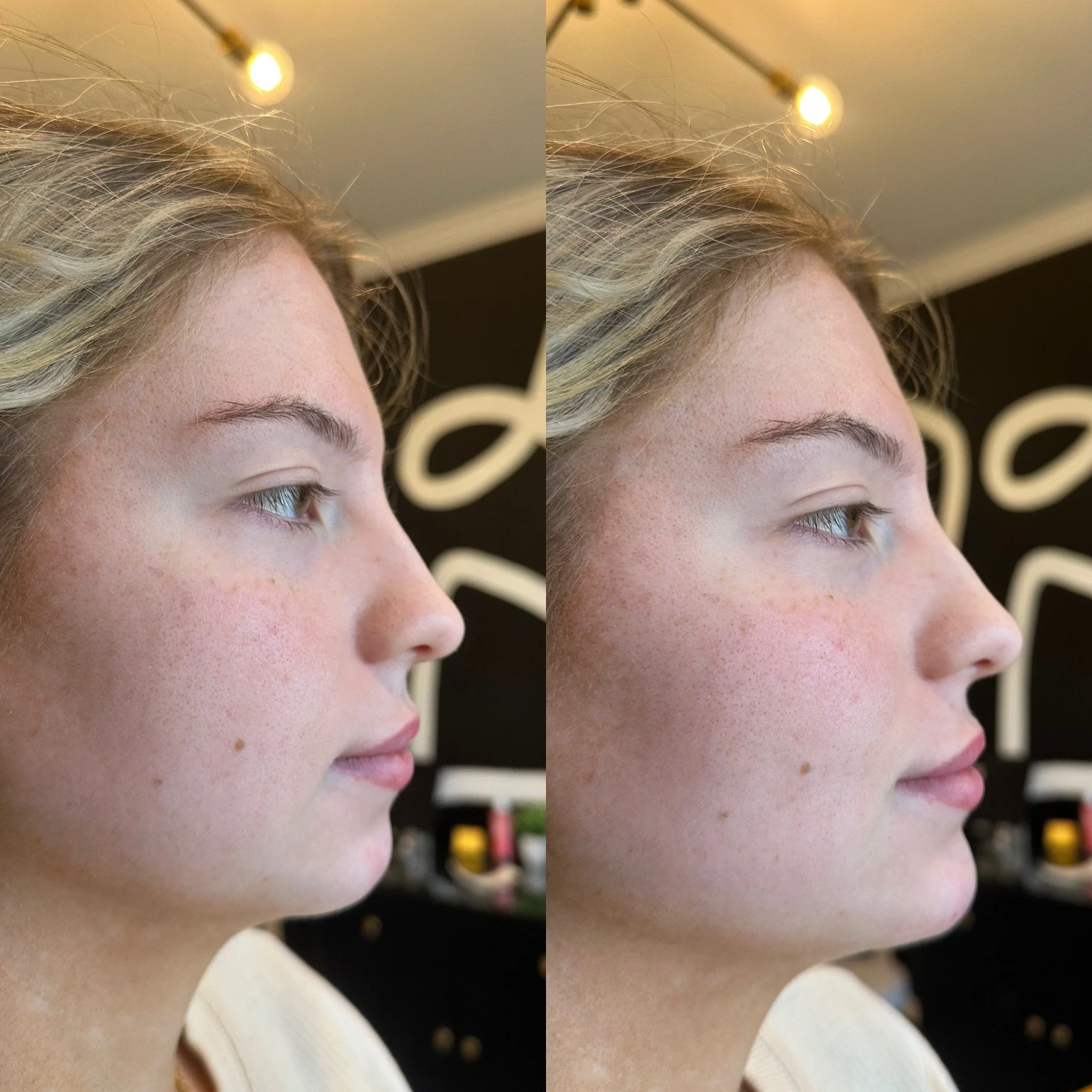 Chin Filler 1 syringe
