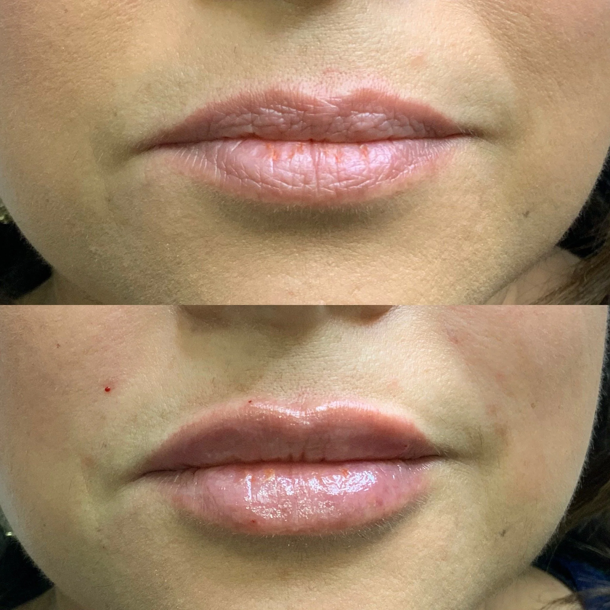 Lip Filler