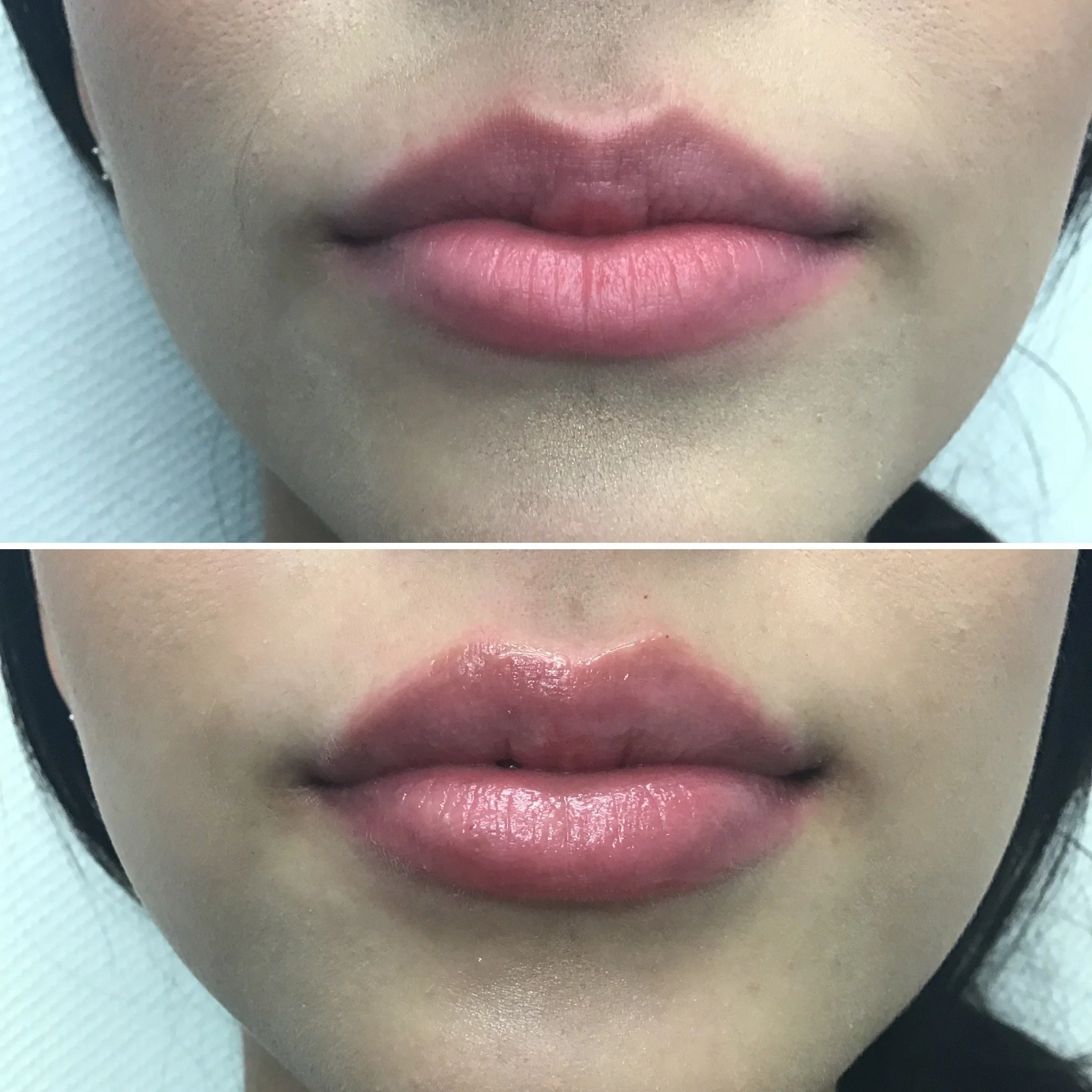 Lip Filler