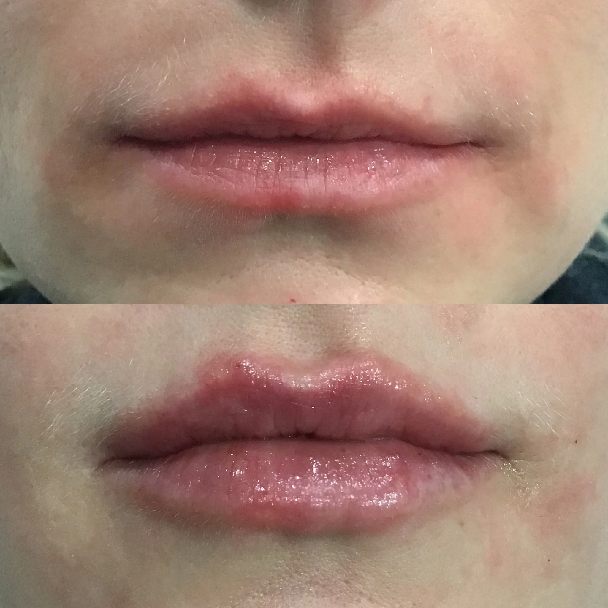 Lip Filler