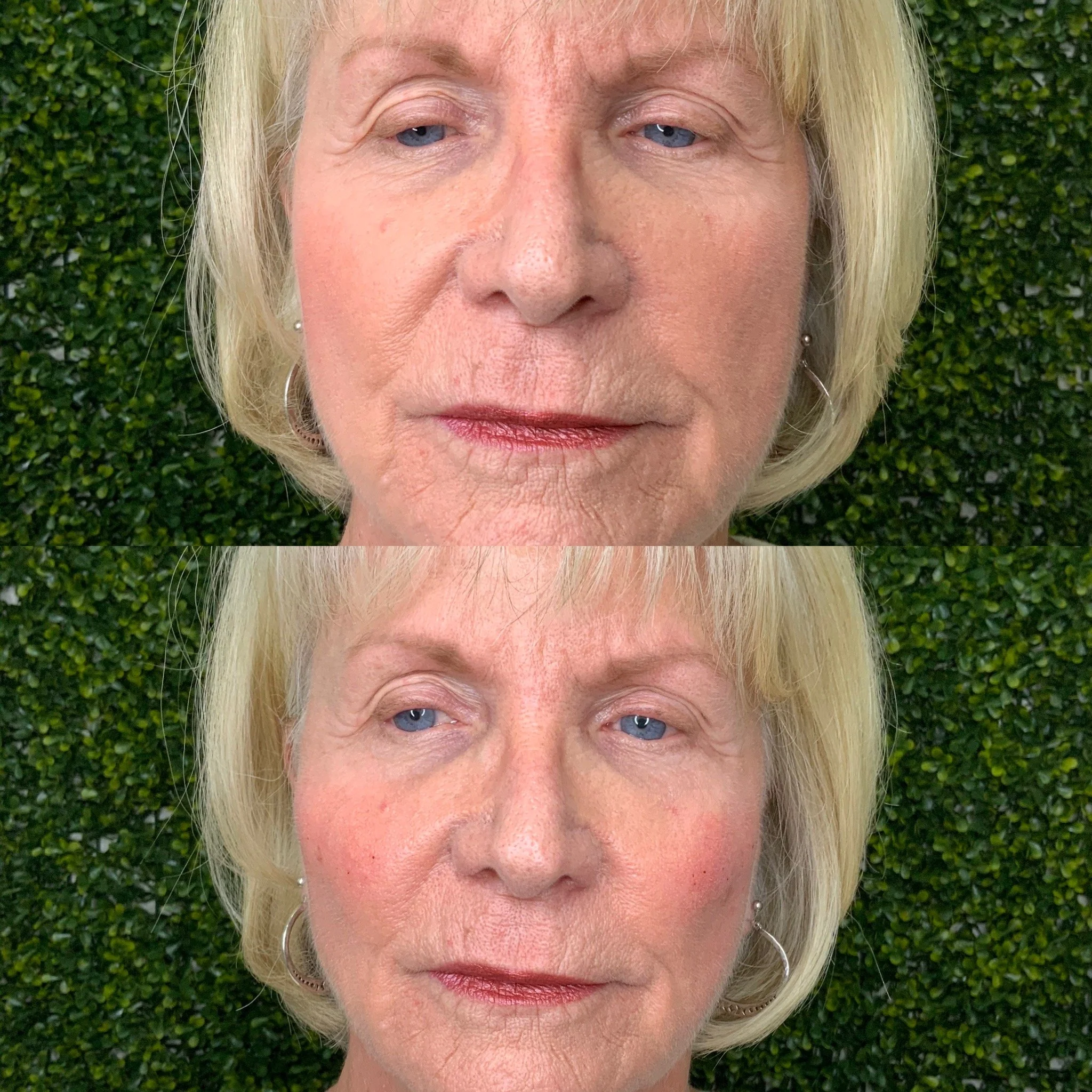 Cheek Filler