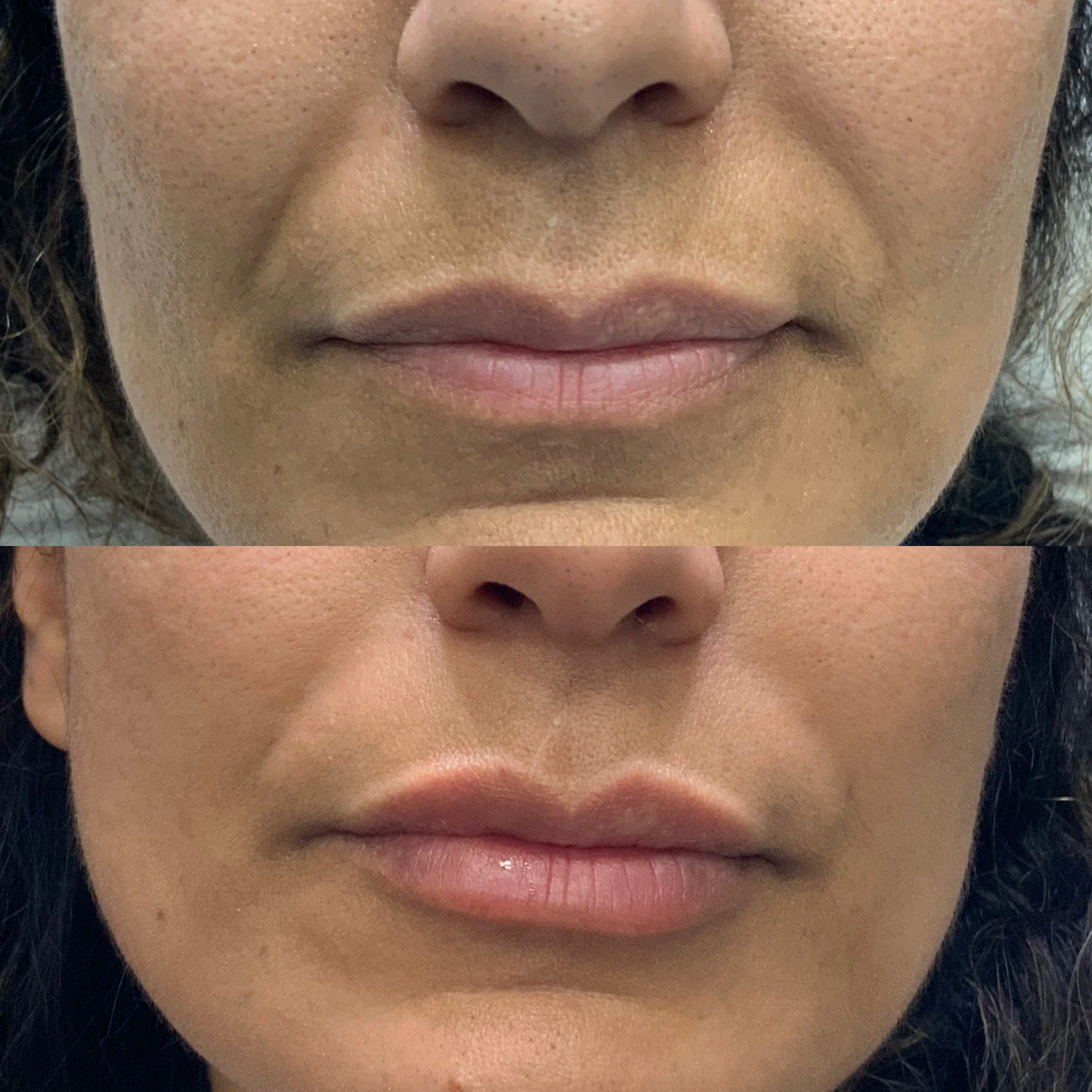 Lip Filler