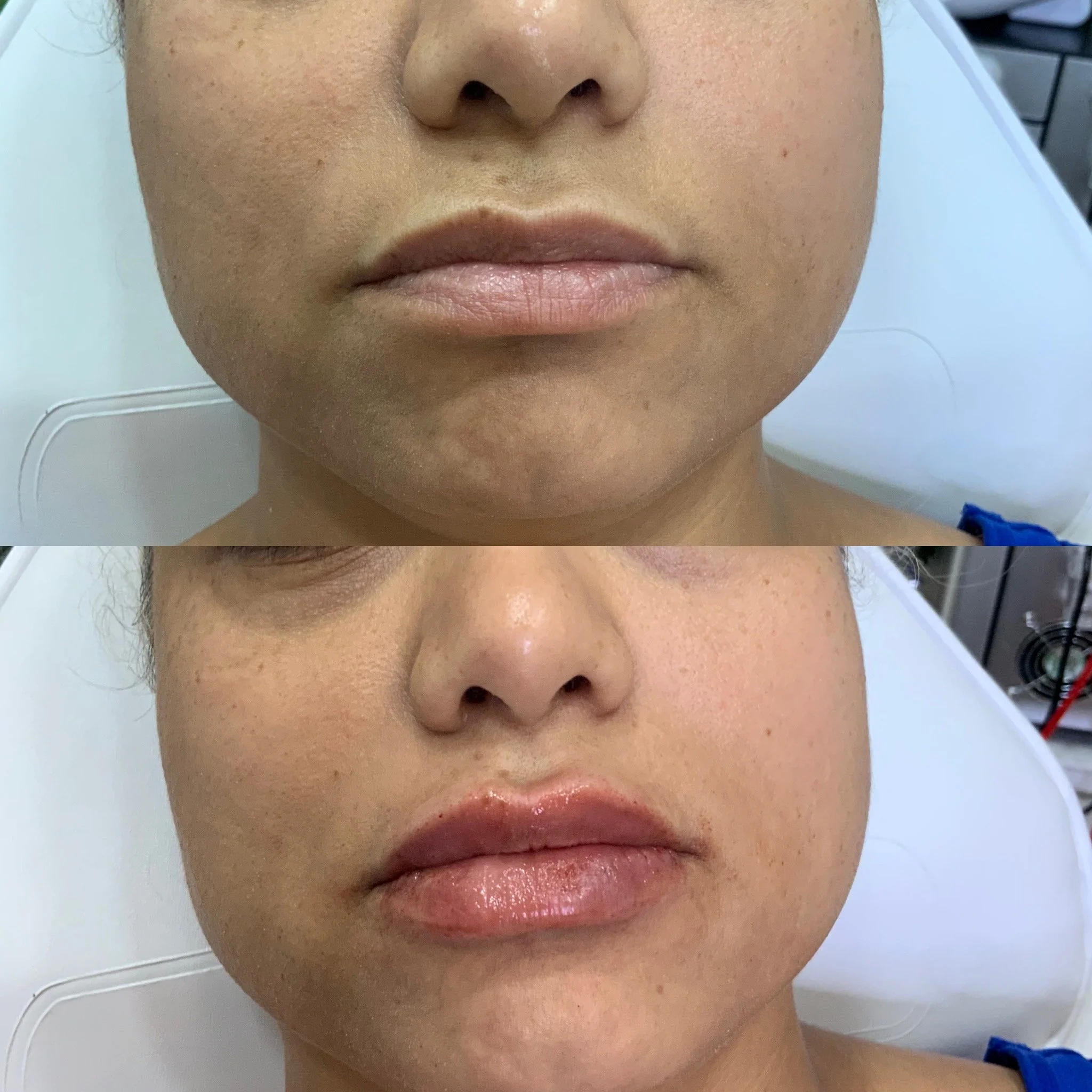 Lip Filler