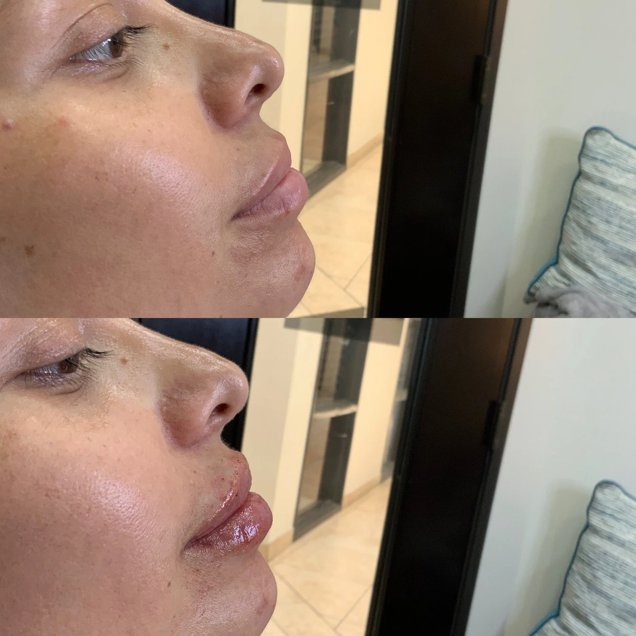 Lip FIller